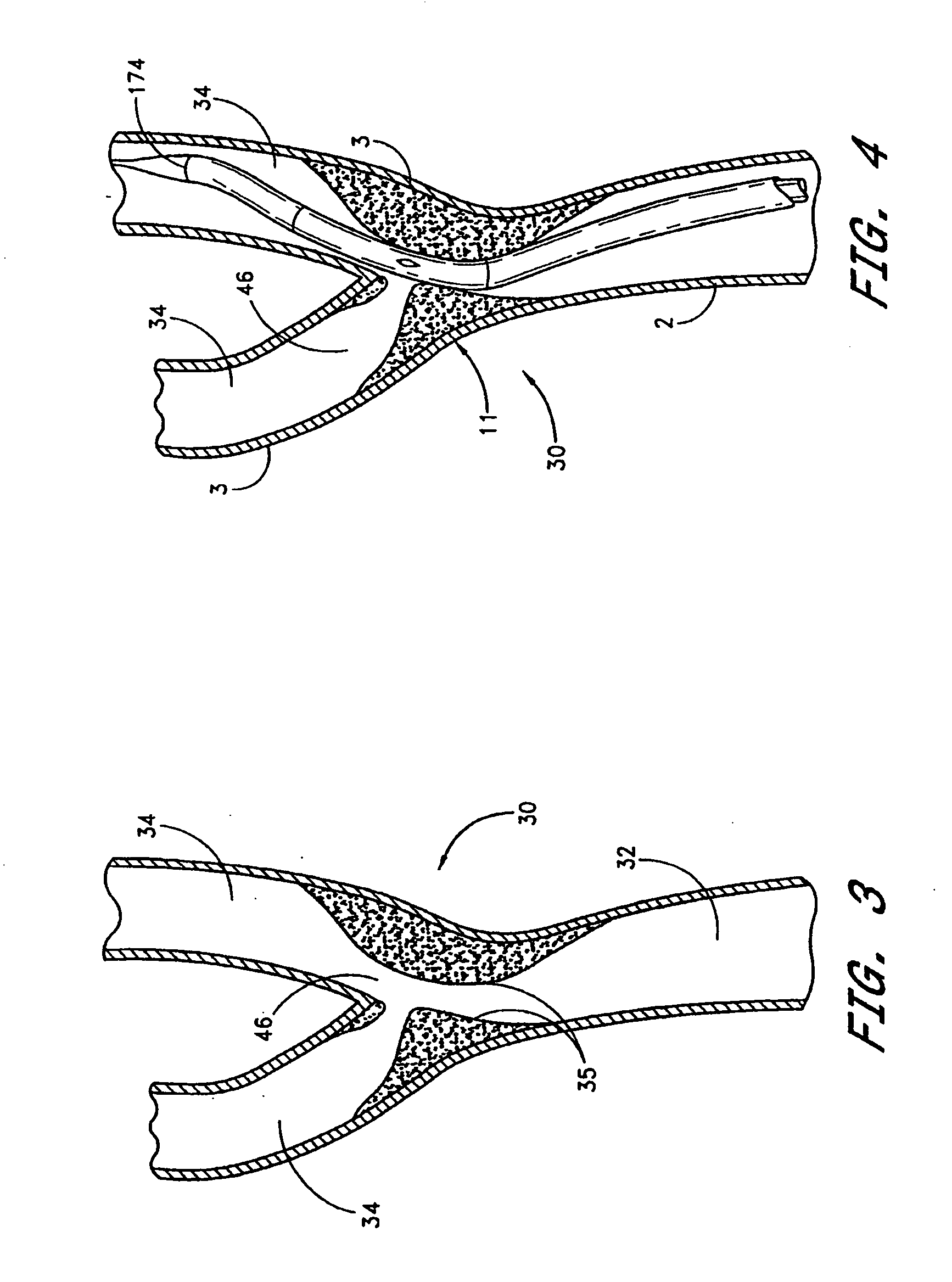 Noncylindrical stent deployment system for treating vascular bifurcations