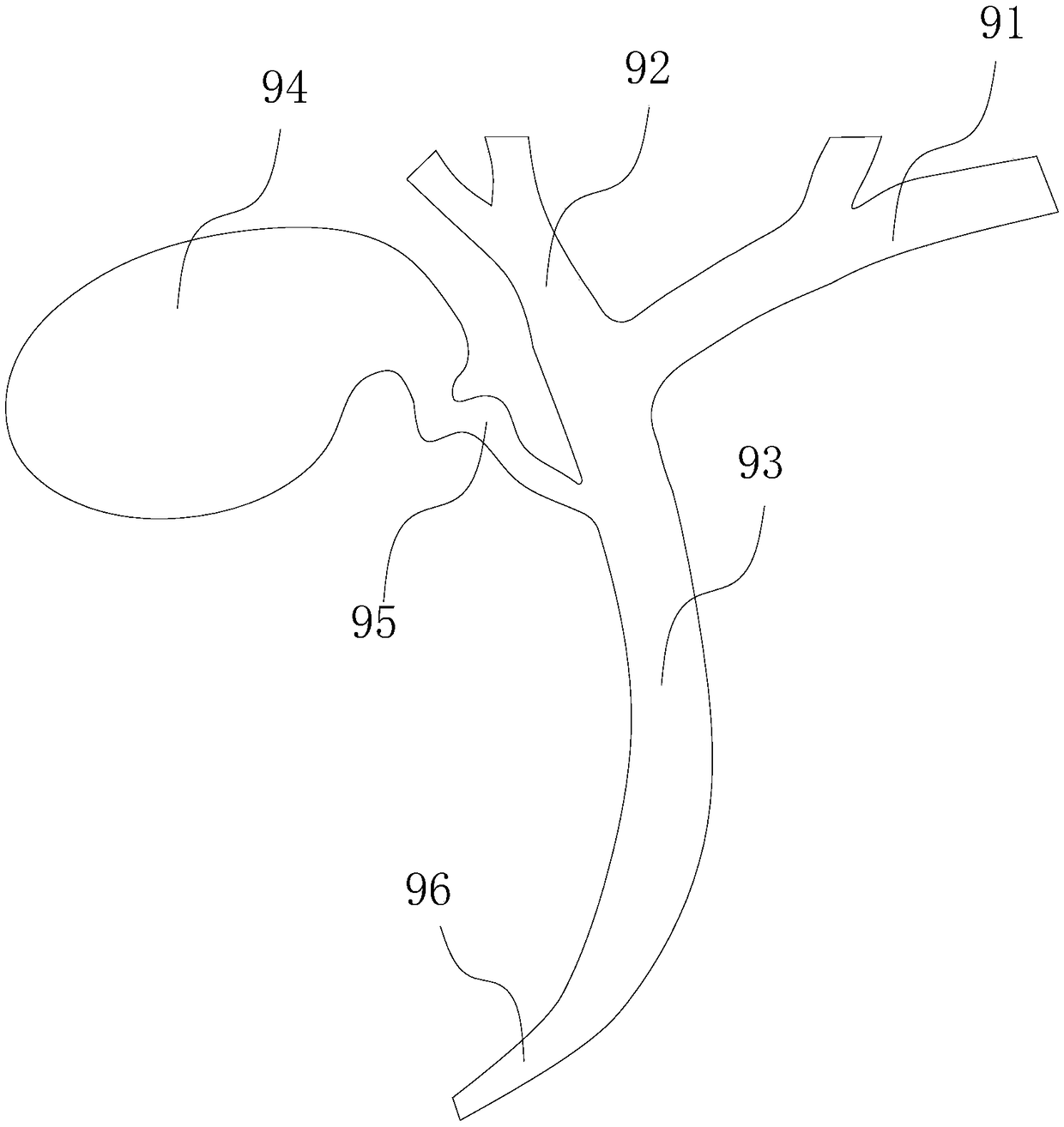 Intrahepatic bile duct coated stent and use method thereof
