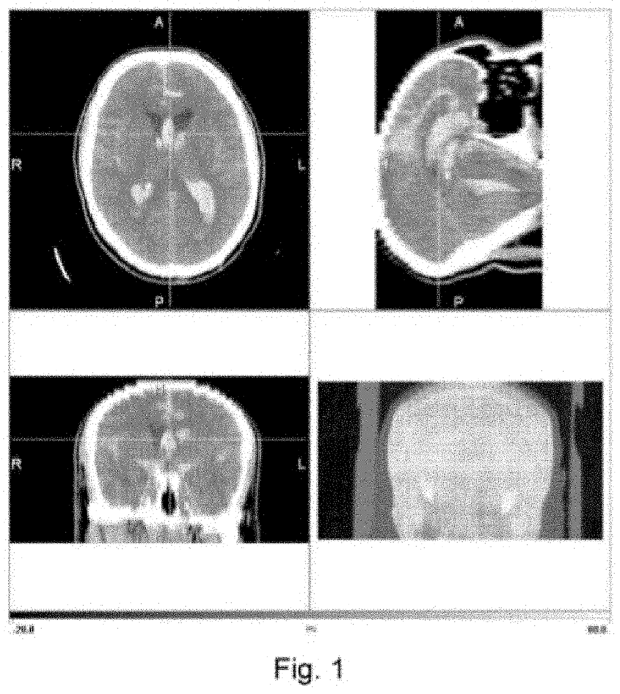 Method for predicting or prognosticating the risk of death or vasospasm in a patient with a subarachnoid hemorrhage