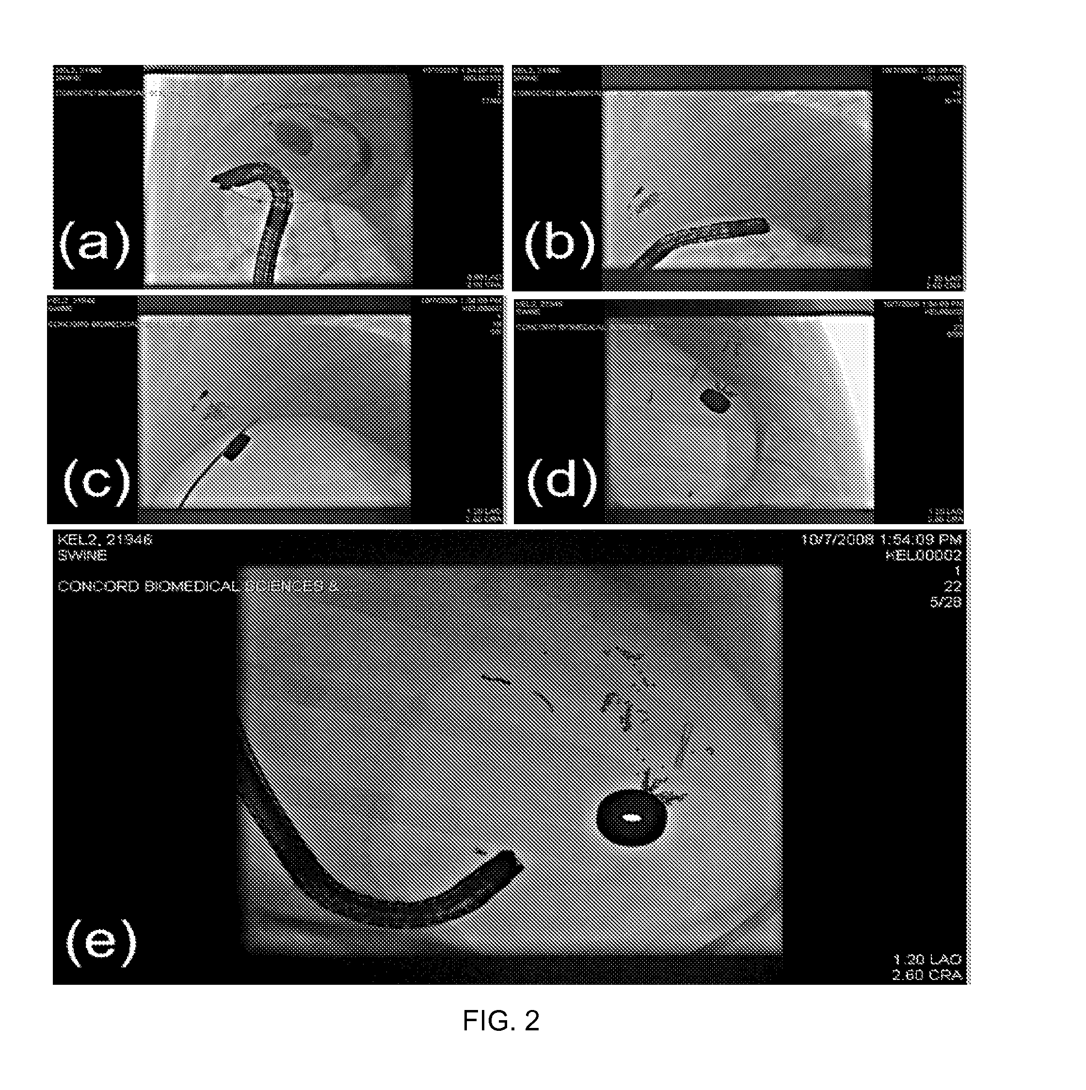 Methods and apparatus for magnet-induced compression anastomosis between adjacent organs