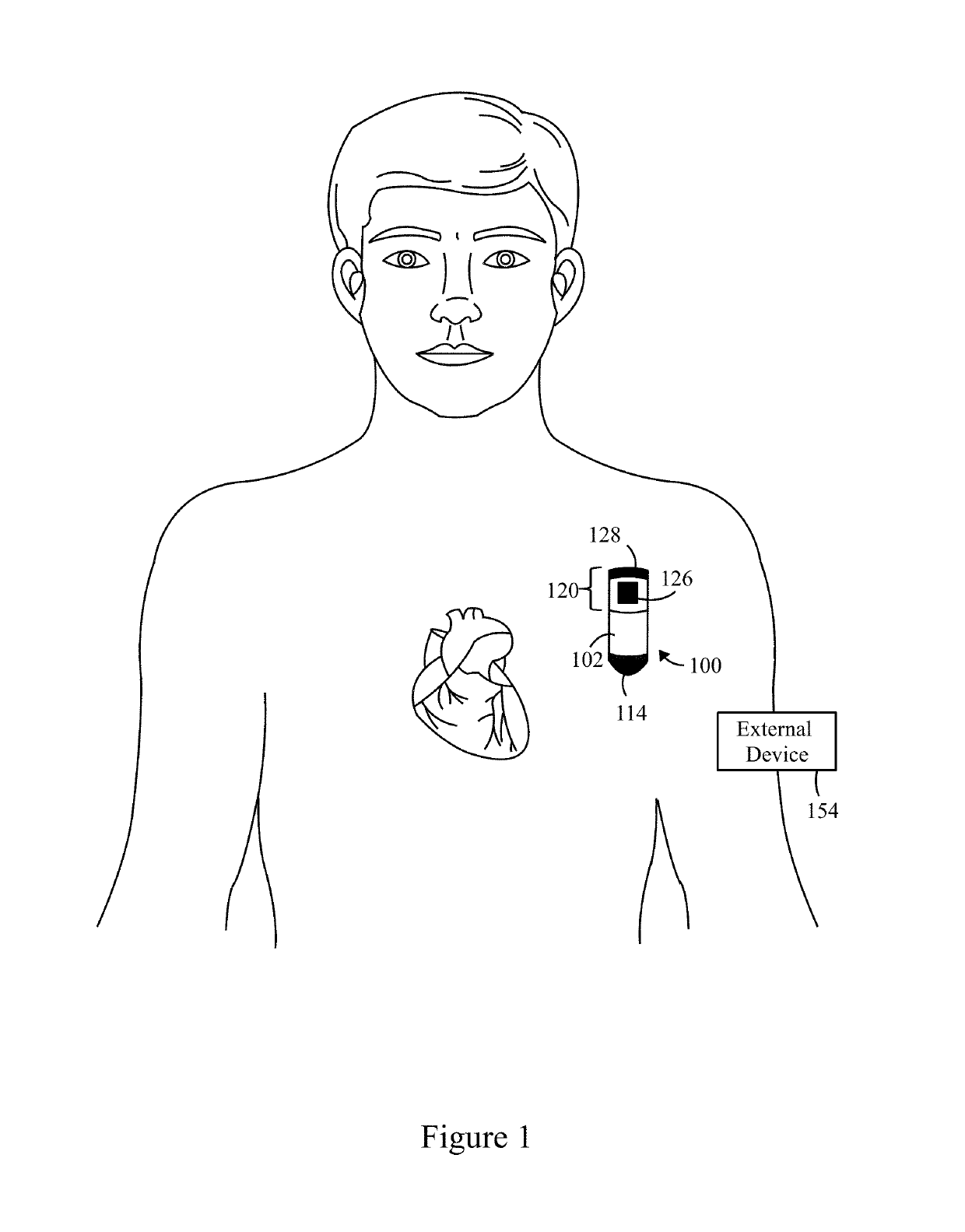 Method and system to detect r-waves in cardiac arrhythmic patterns