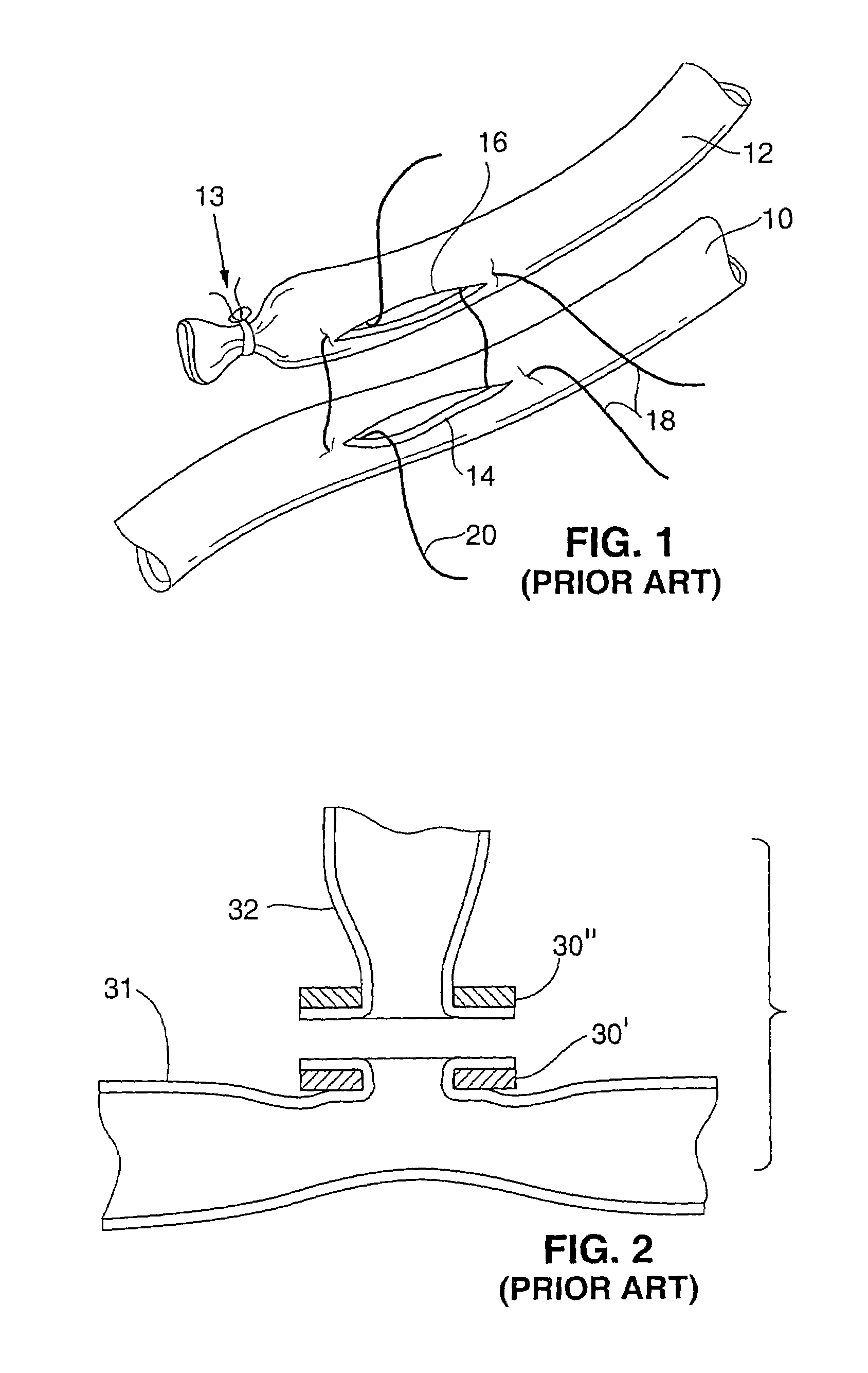Method and apparatus for performing anastomosis with eversion of tissue edges and joining of exposed intima of the everted tissue