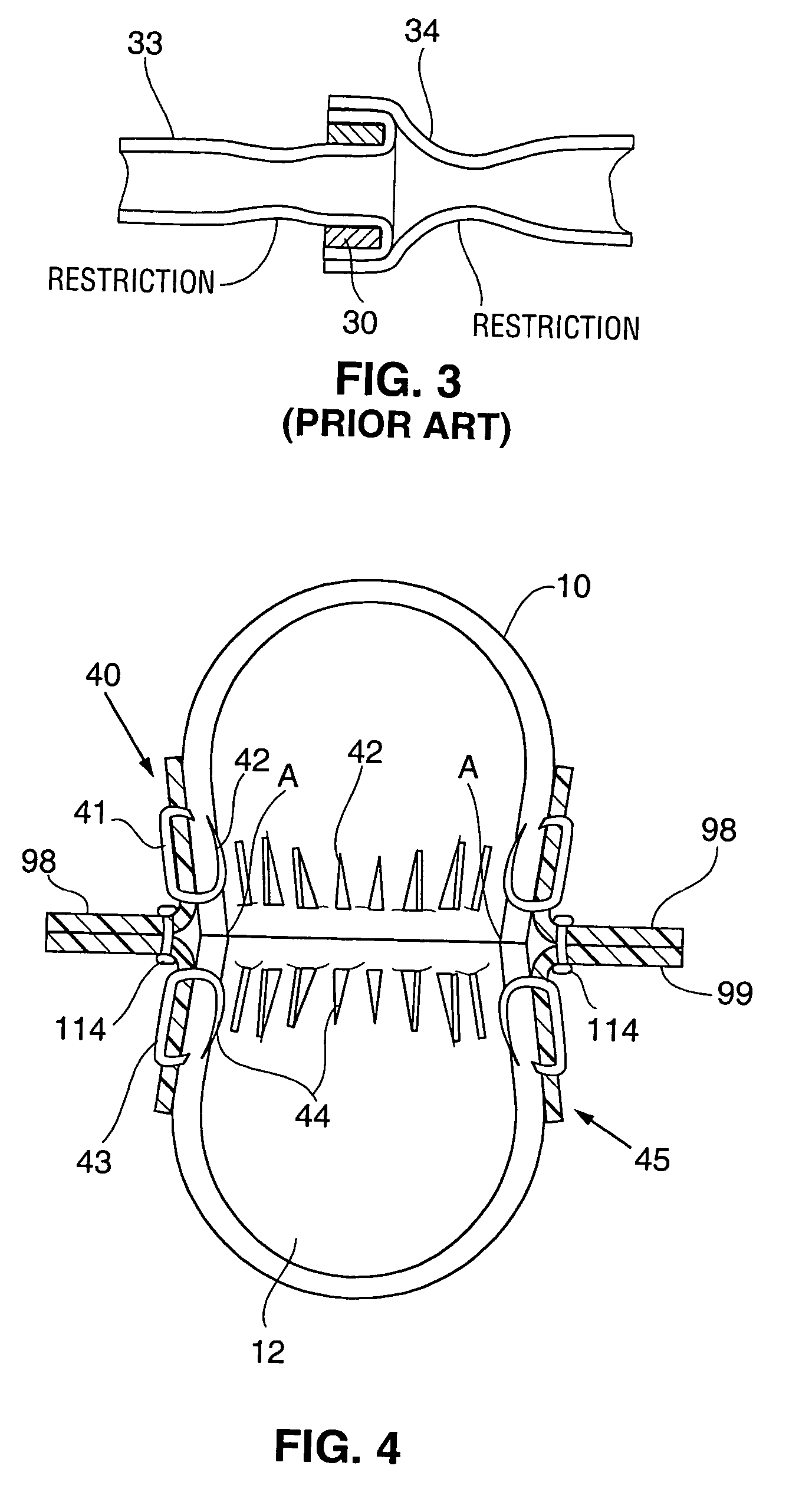 Method and apparatus for performing anastomosis with eversion of tissue edges and joining of exposed intima of the everted tissue