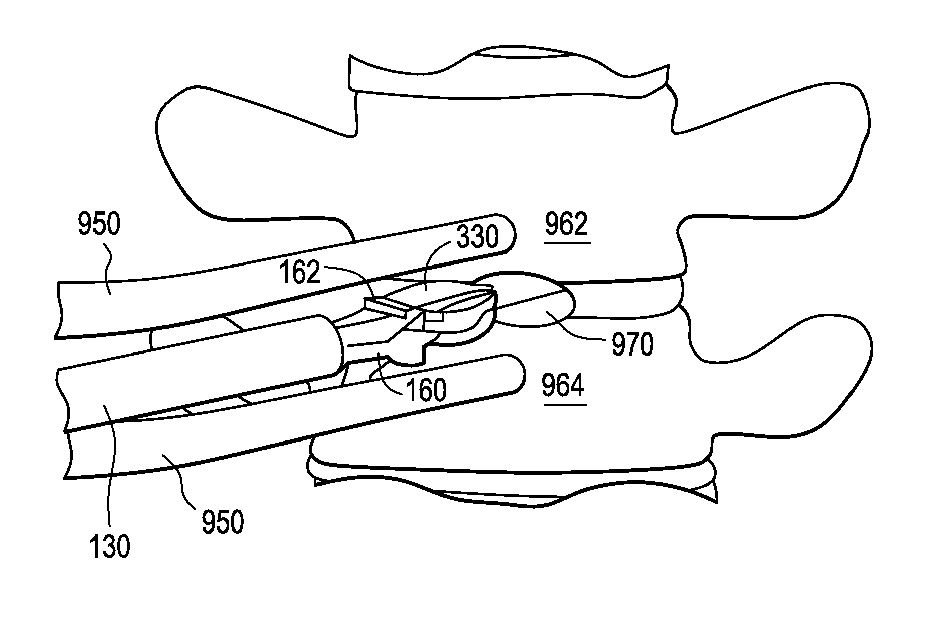Novel Implant Inserter Having a Laterally-Extending Dovetail Engagement Feature