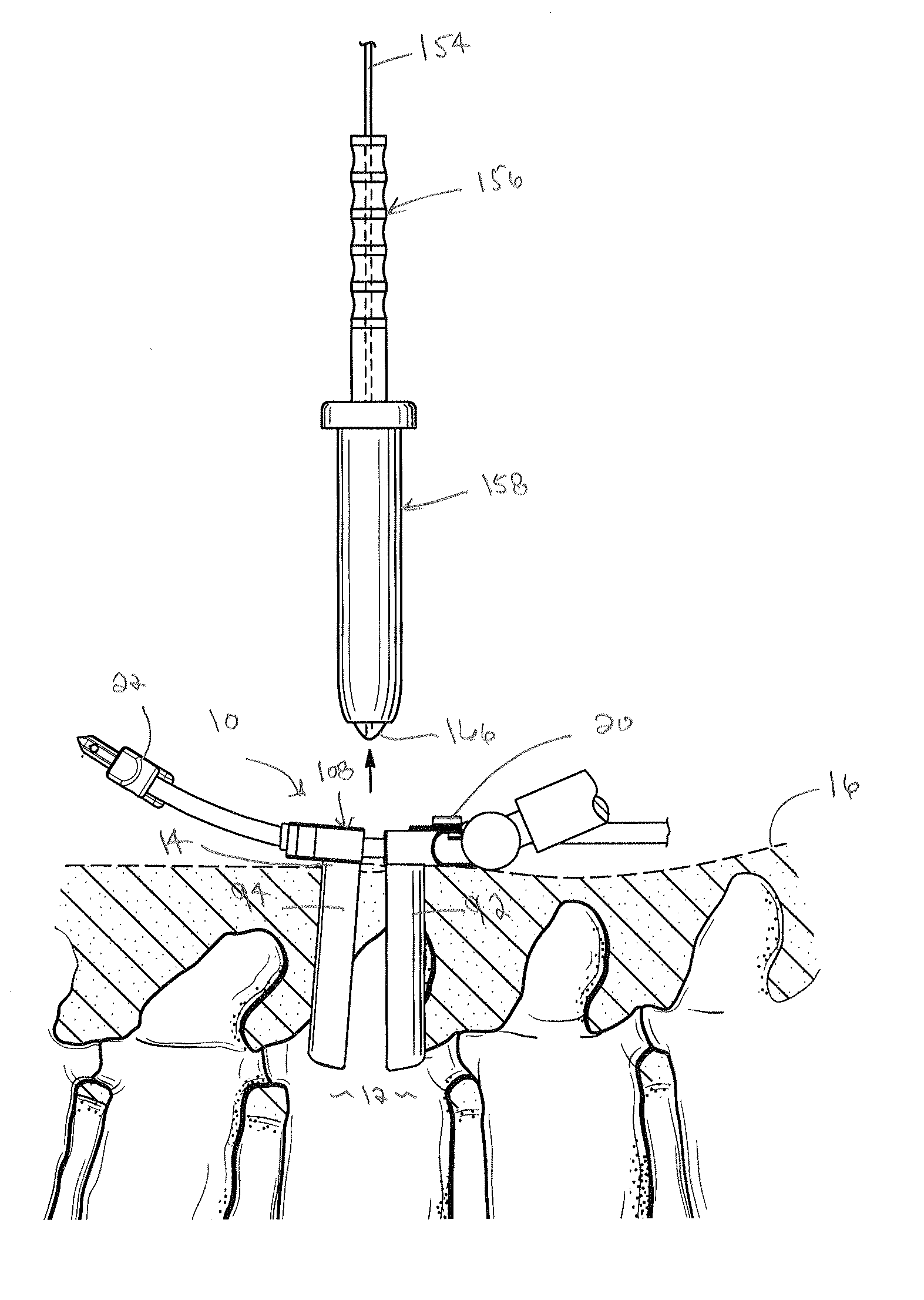 Surgical access system and method of using the same