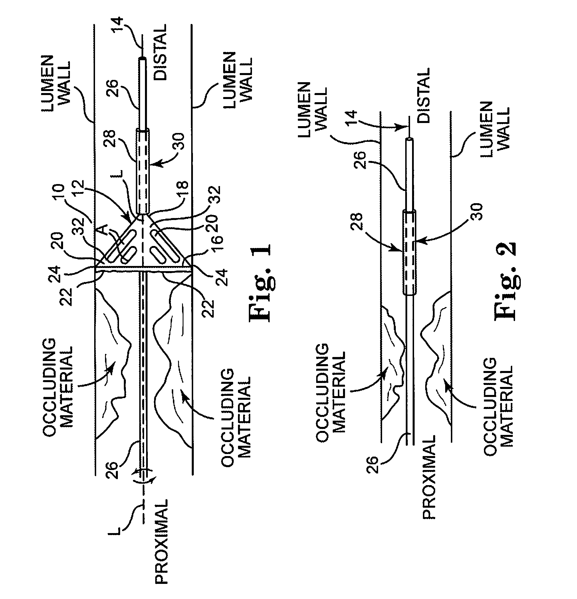 Cutting and coring atherectomy device and method