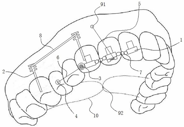 Auxiliary anterior tooth torque control device