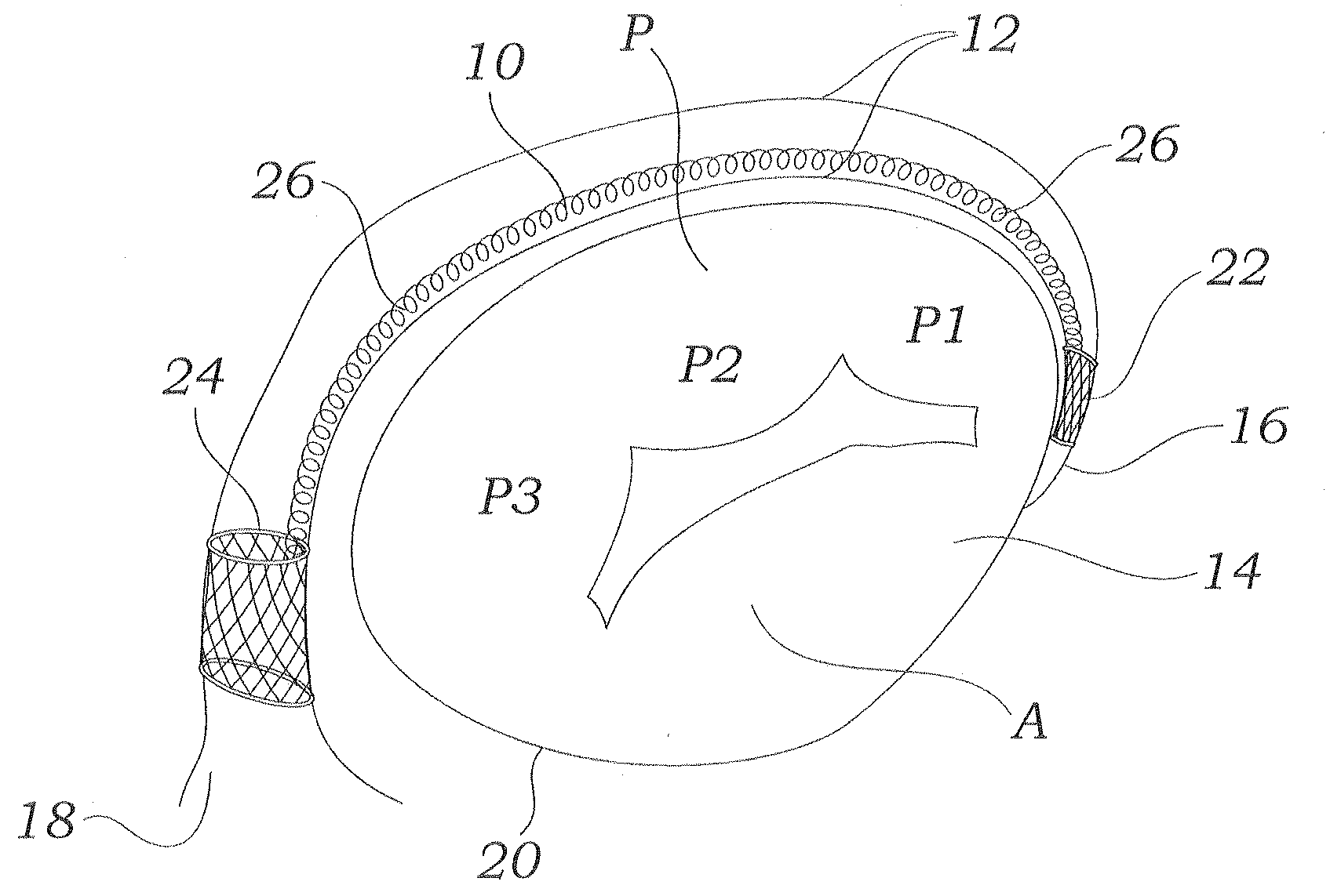 Coiled implant for mitral valve repair