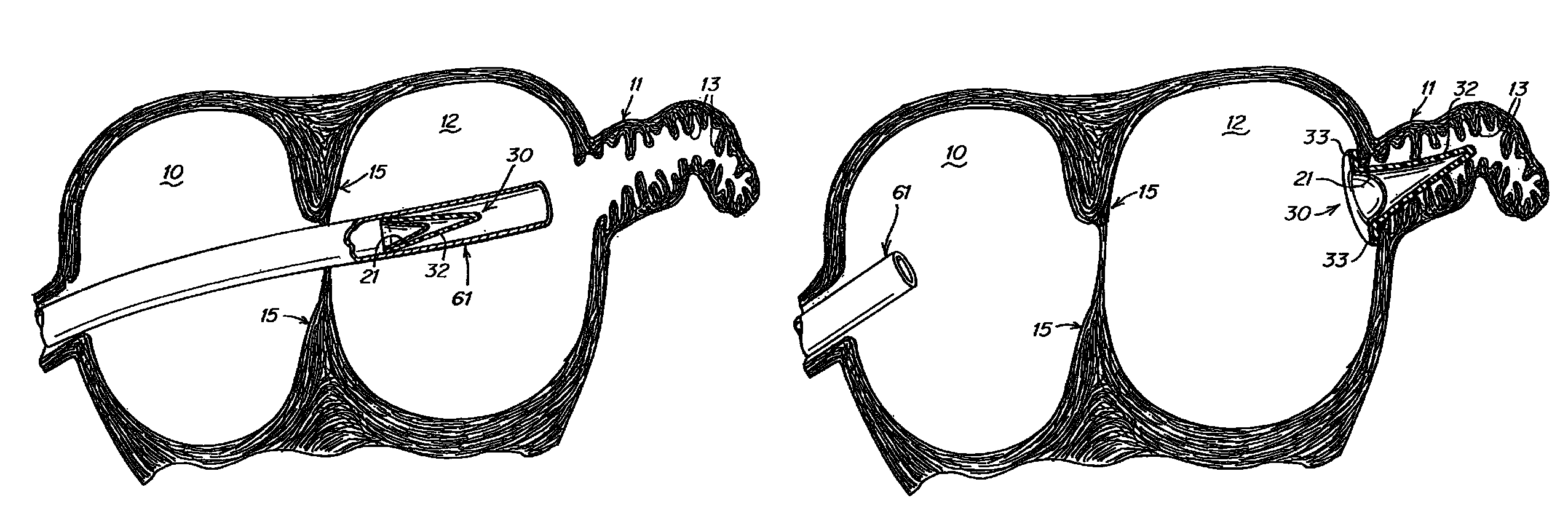 Device and methods for preventing formation of thrombi in the left atrial appendage