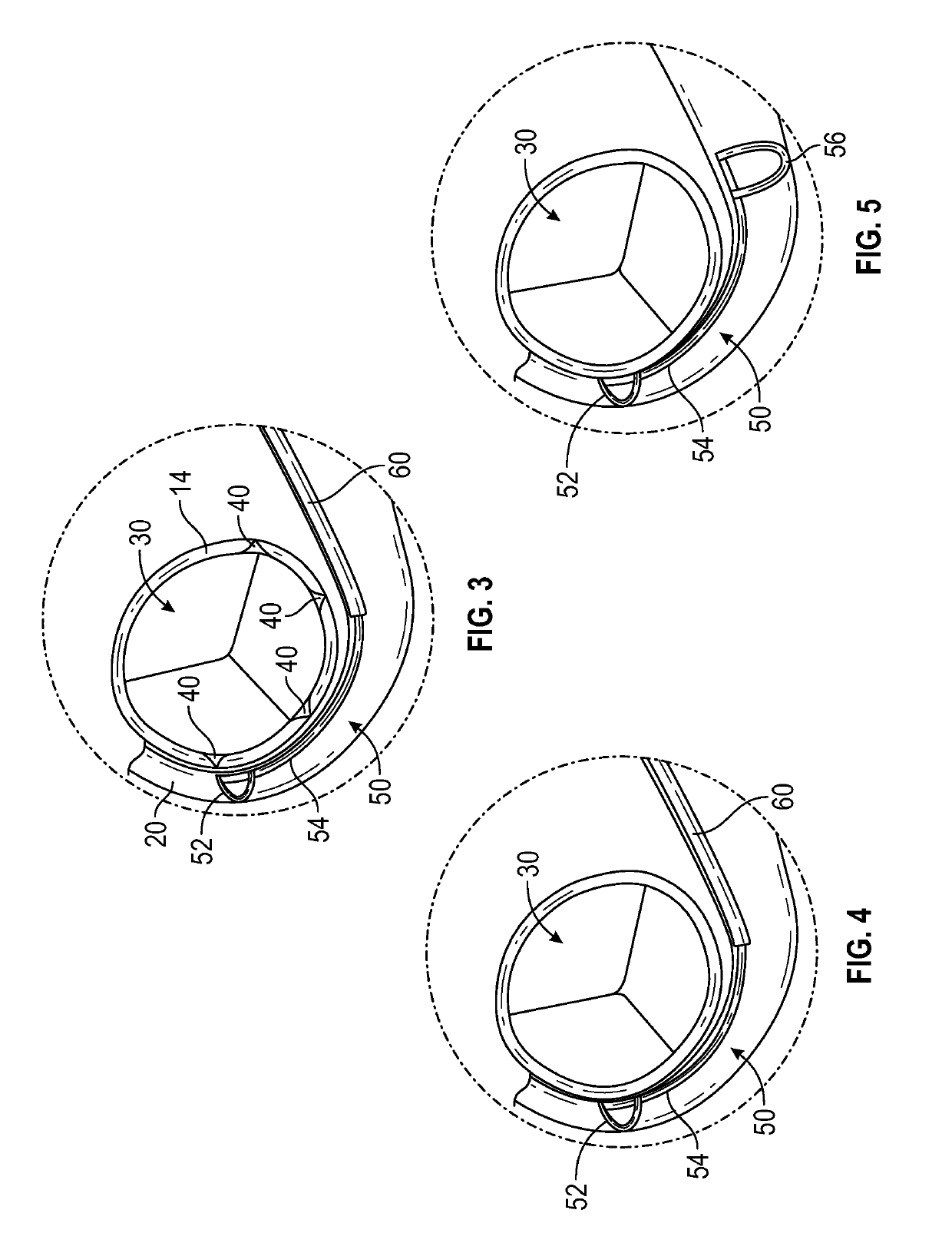 Methods and devices for reducing paravalvular leakage