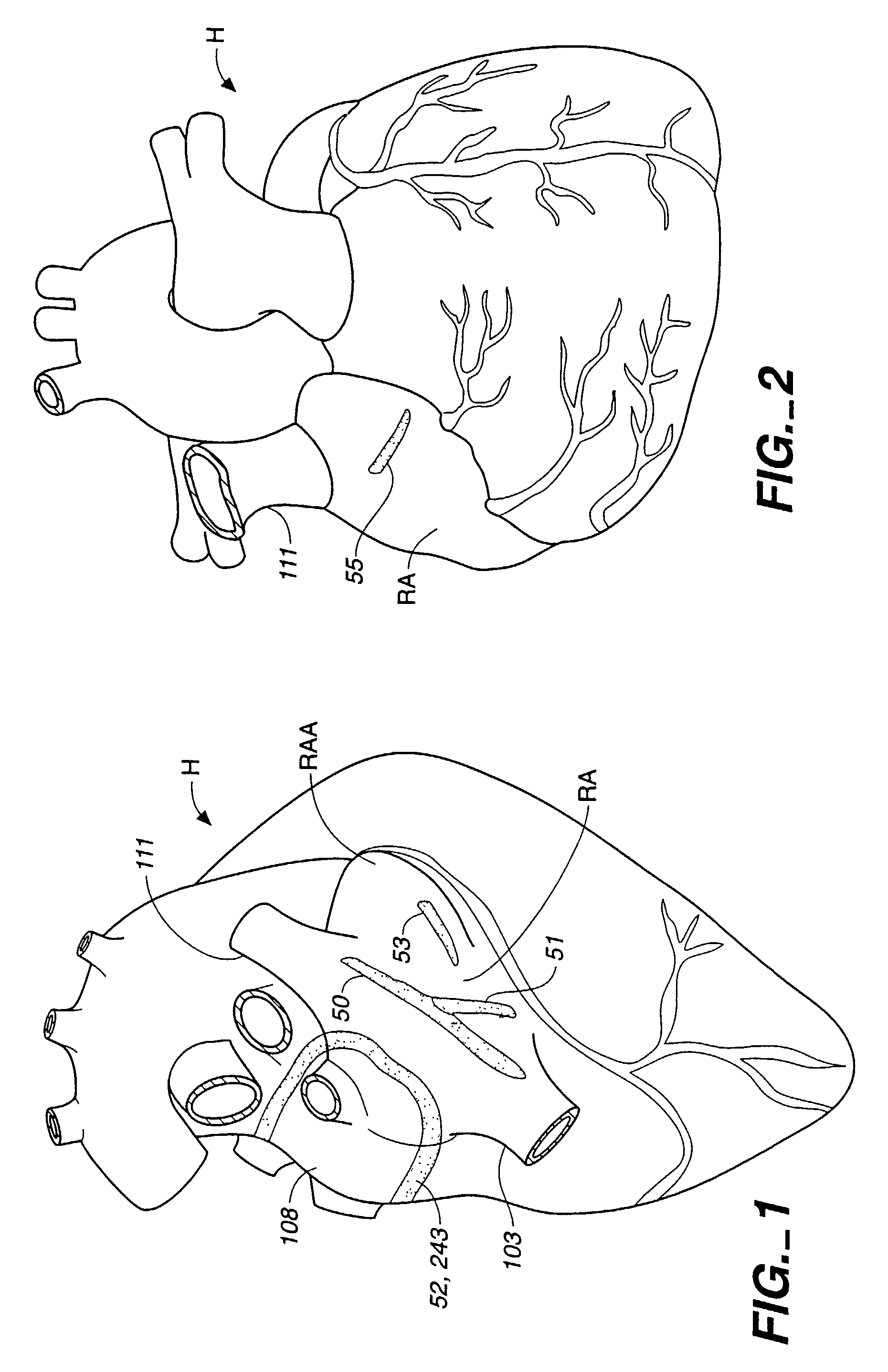 Surgical system and procedure for treatment of medically refractory atrial fibrillation