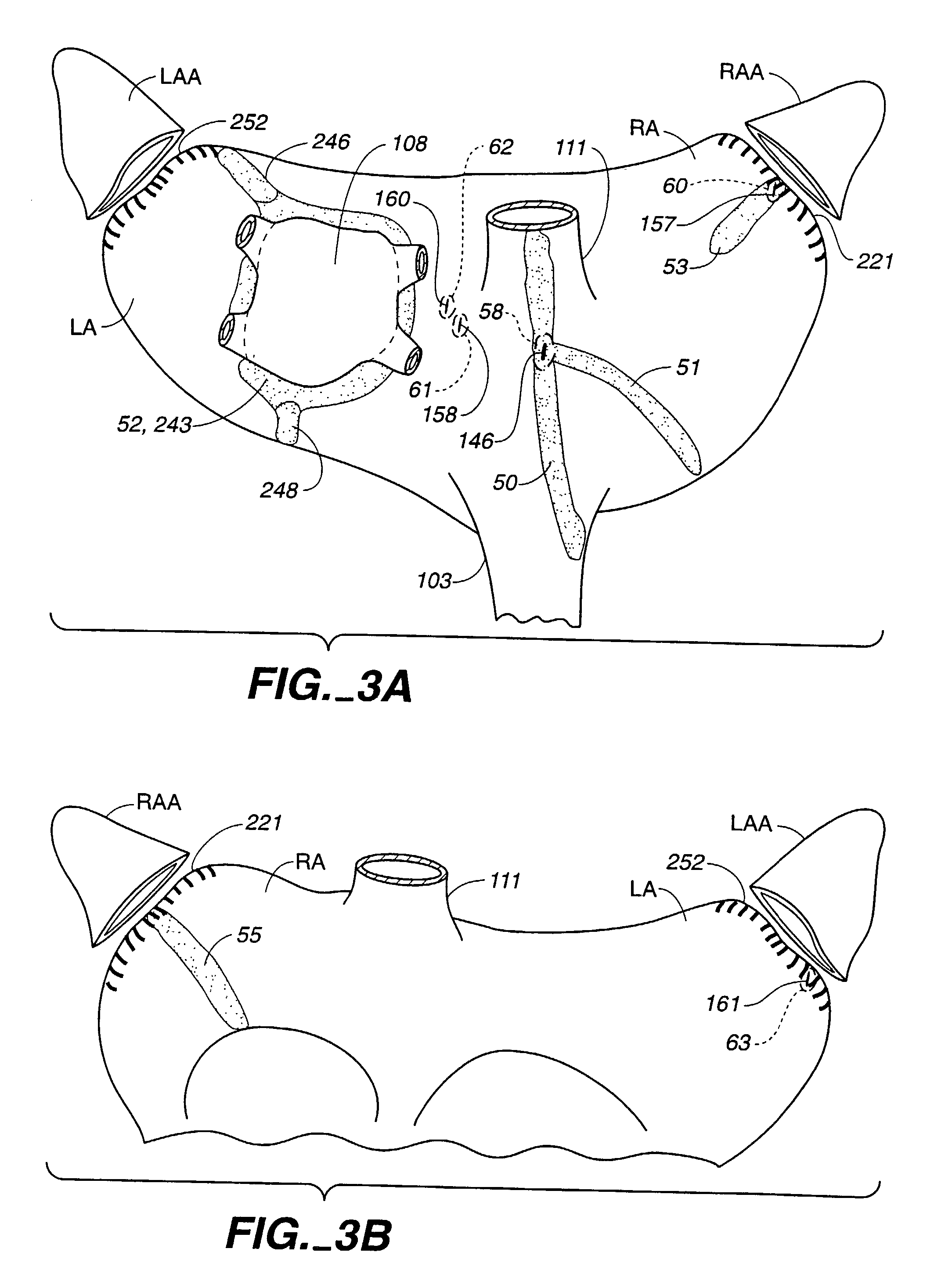 Surgical system and procedure for treatment of medically refractory atrial fibrillation