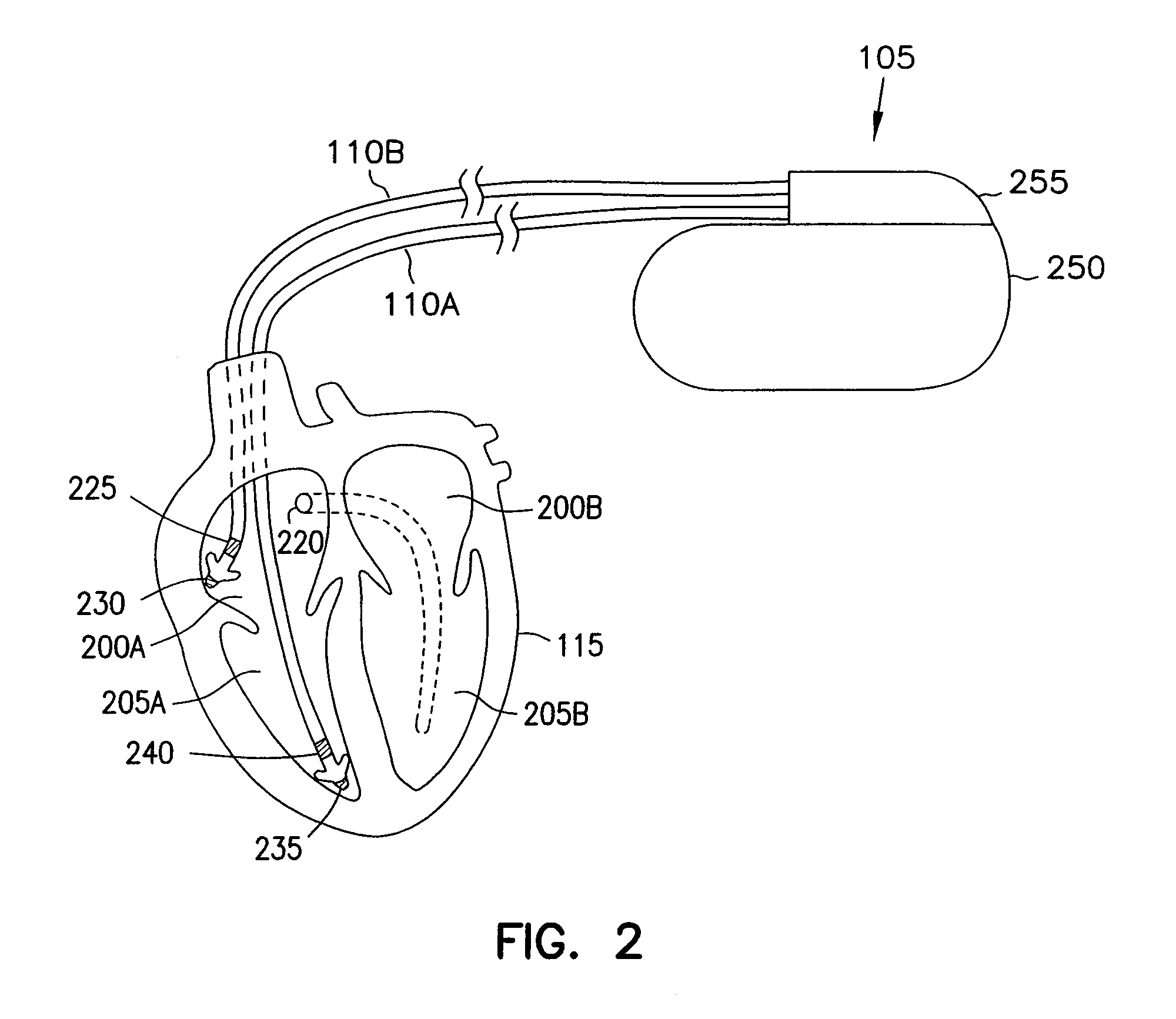 Method and apparatus for treating irregular ventricular contractions such as during atrial arrhythmia