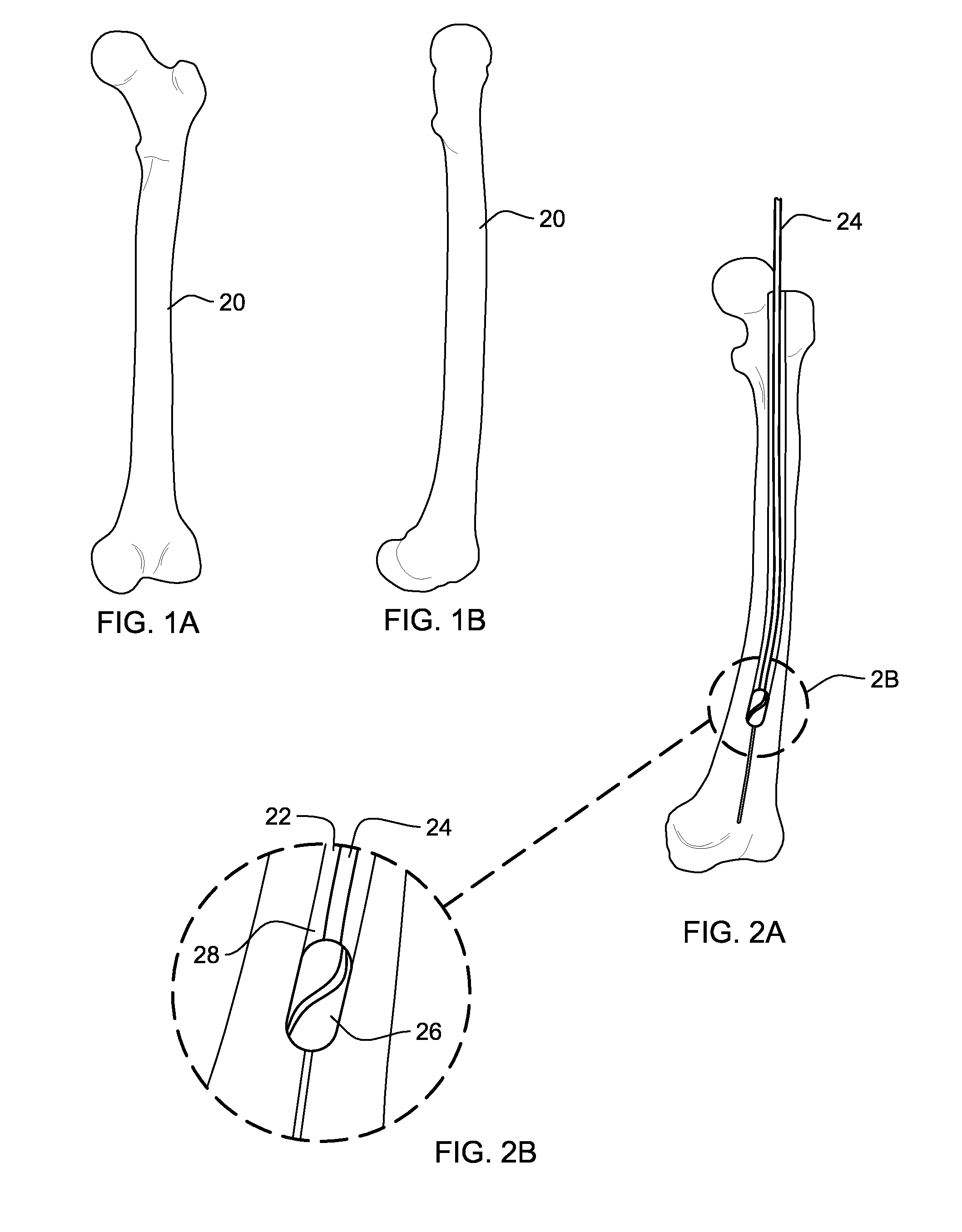 Intramedullary transillumination apparatus, surgical kit and method for accurate placement of locking screws in long bone intramedullary rodding