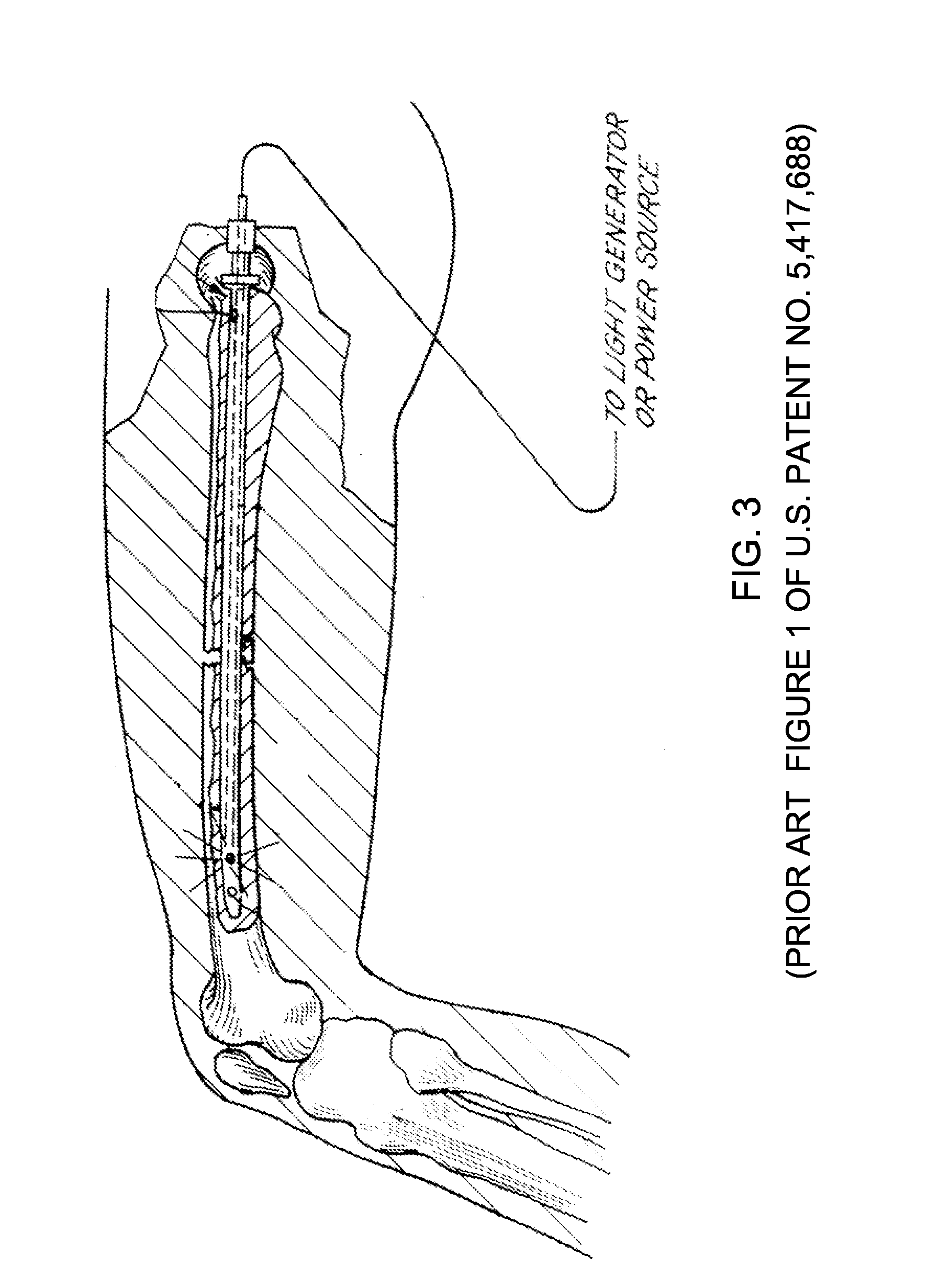 Intramedullary transillumination apparatus, surgical kit and method for accurate placement of locking screws in long bone intramedullary rodding