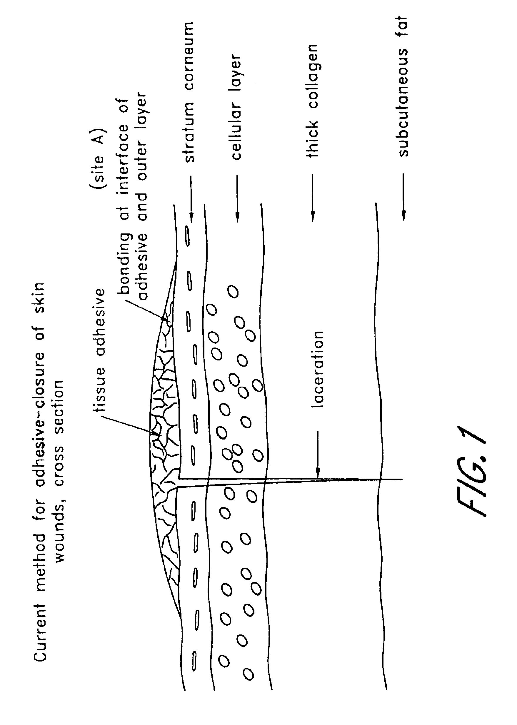 Adhesive including medicament and device and method for applying same