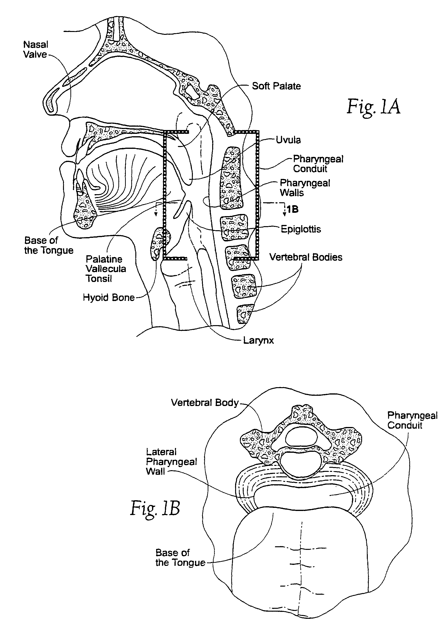 Magnetic force device, systems, and methods for resisting tissue collapse within the pharyngeal conduit