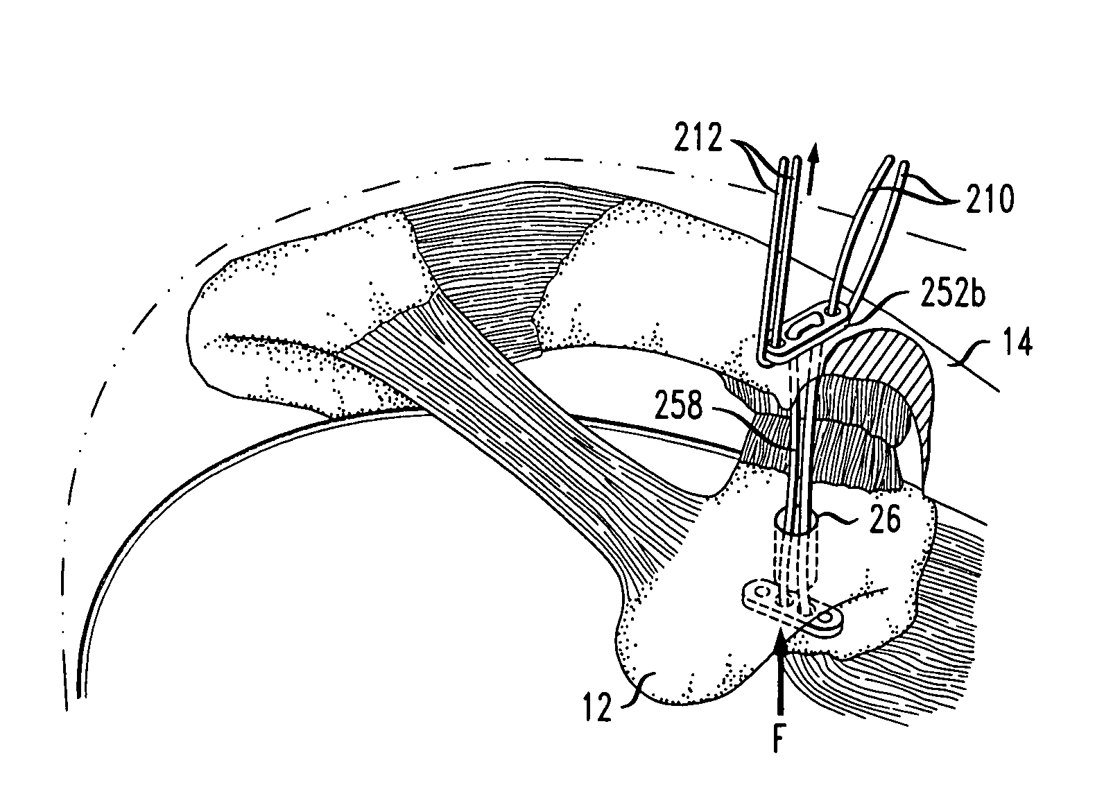 Device for treatment of acromioclavicular joint dislocations
