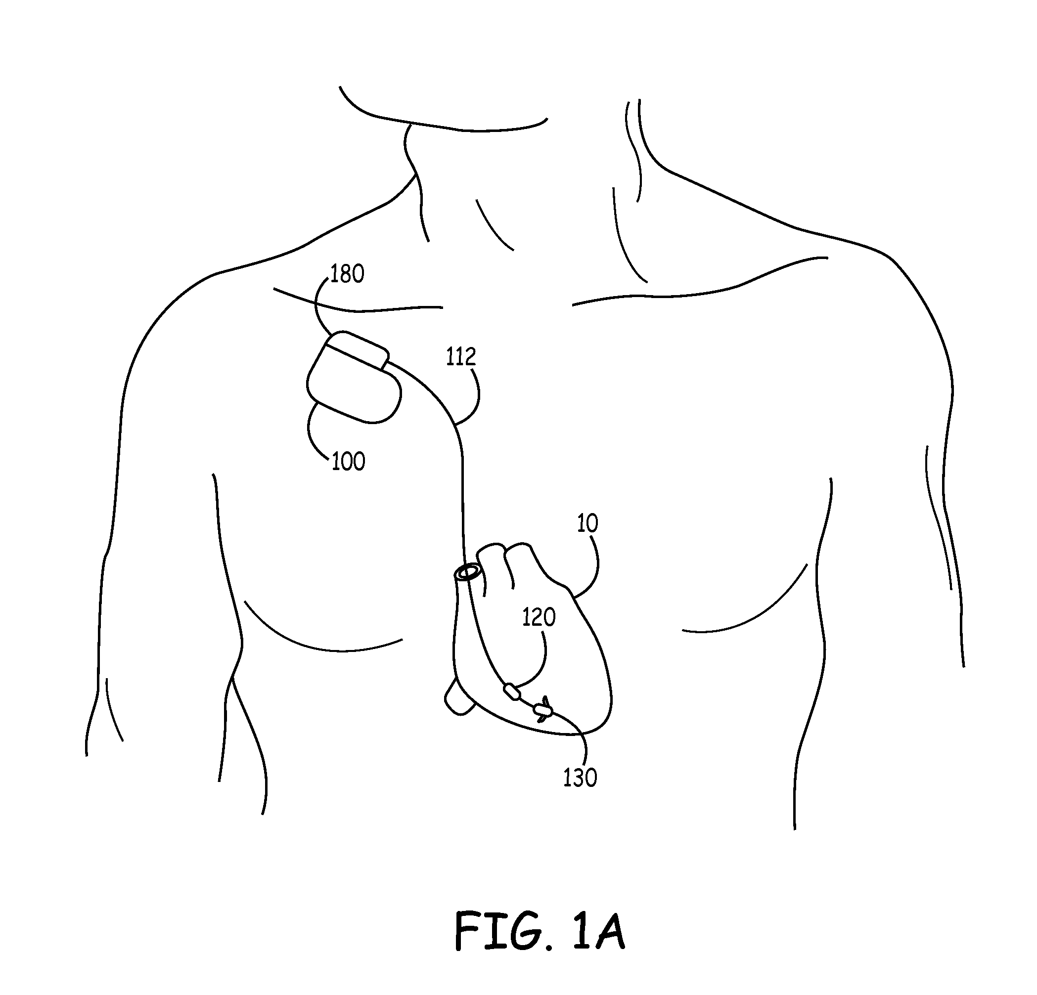 Heart failure monitor quicklook summary for patient management systems