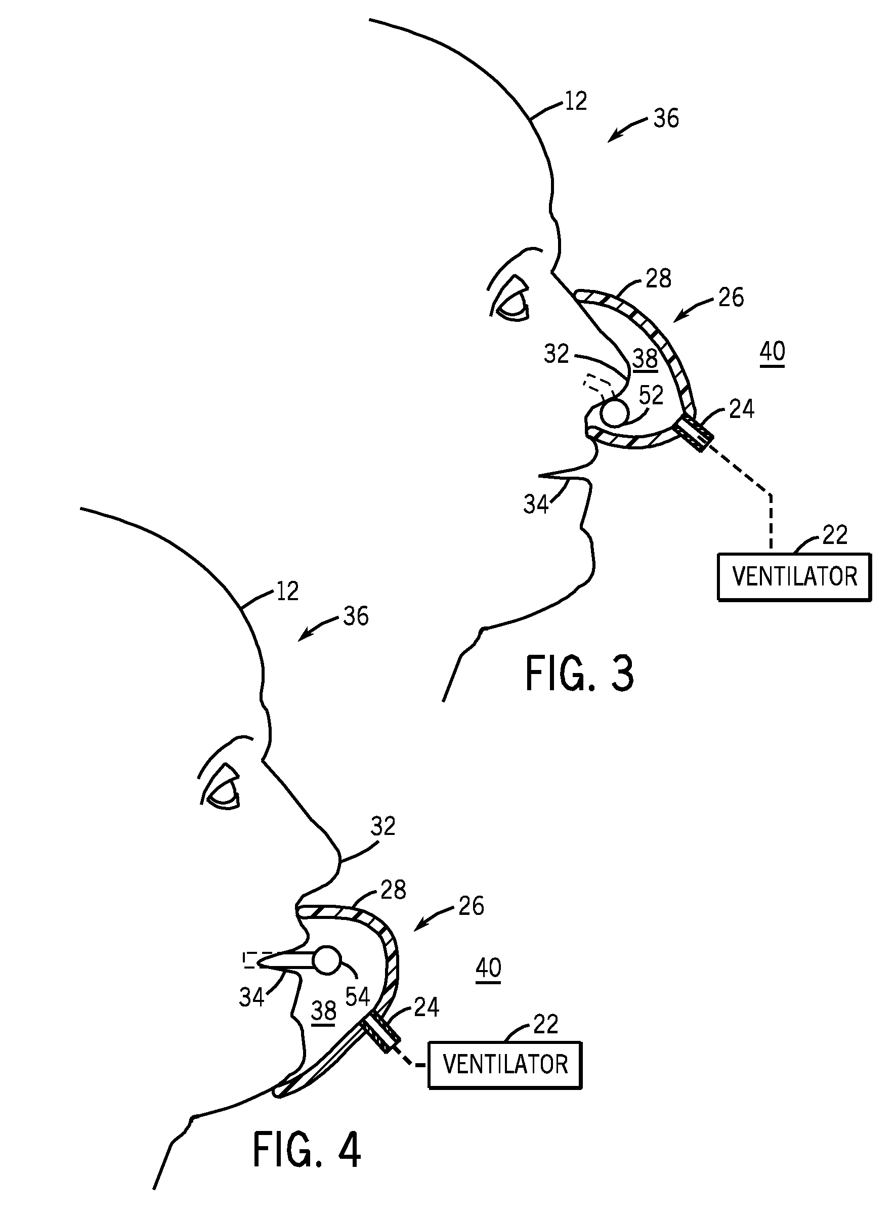 Respiratory monitoring with cannula receiving first respiratory airflows and second respiratory airflows