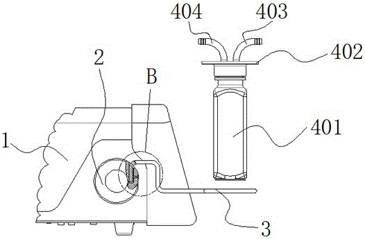 An ultrasonic negative pressure stone removal device in the body