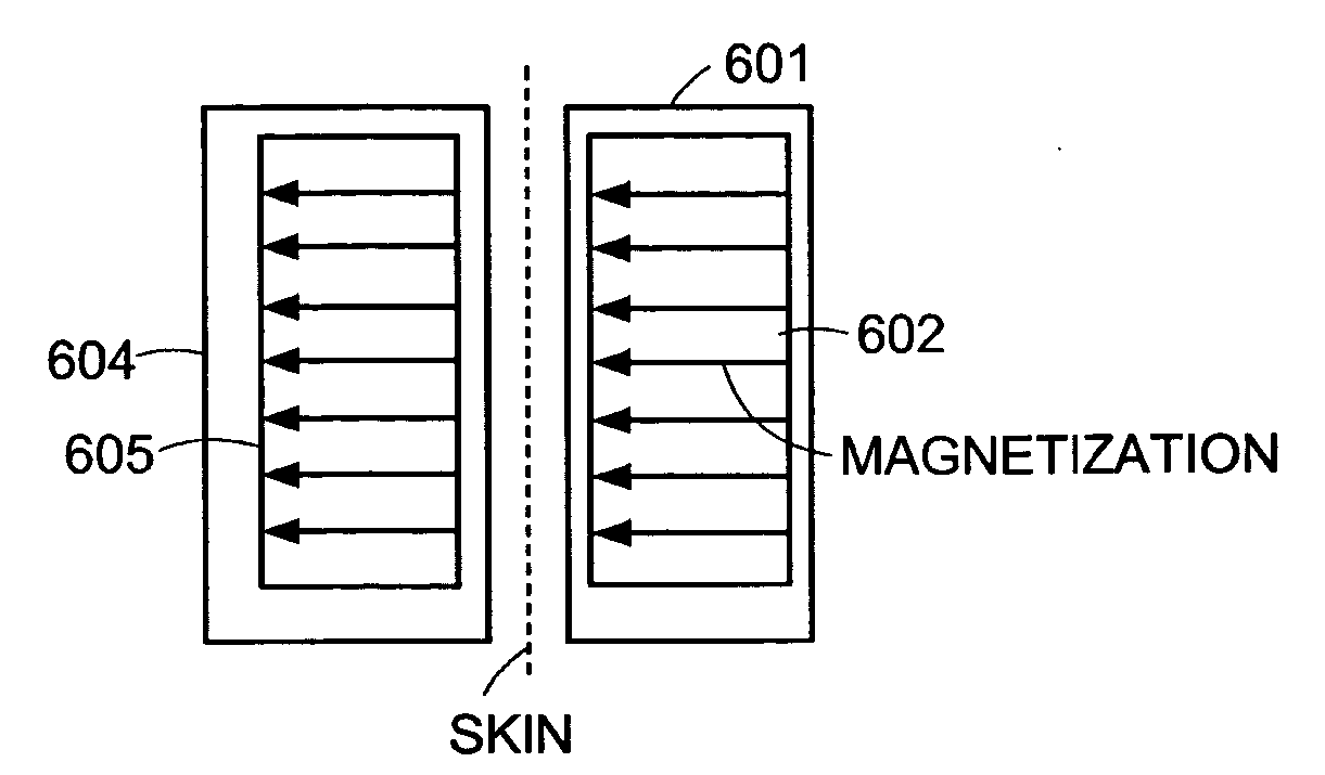 Reducing effect of magnetic and electromagnetic fields on an implant's magnet and/or electronics