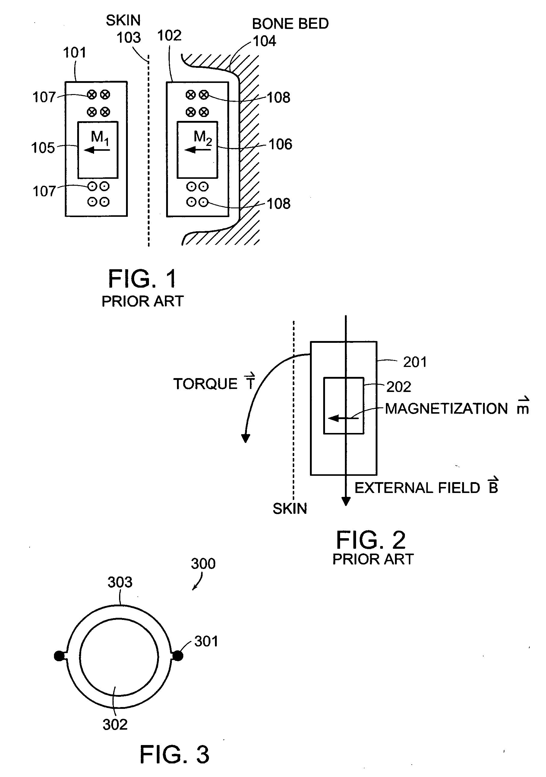 Reducing effect of magnetic and electromagnetic fields on an implant's magnet and/or electronics