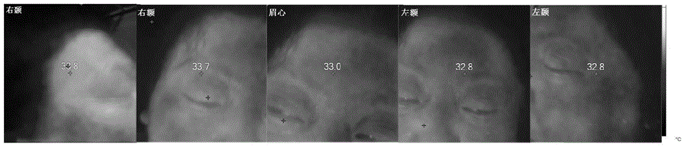 Array type infrared thermal imager and application of array type infrared thermal imager to identifying ischemic stroke and hemorrhagic stroke at early stage