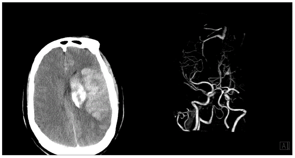 Array type infrared thermal imager and application of array type infrared thermal imager to identifying ischemic stroke and hemorrhagic stroke at early stage