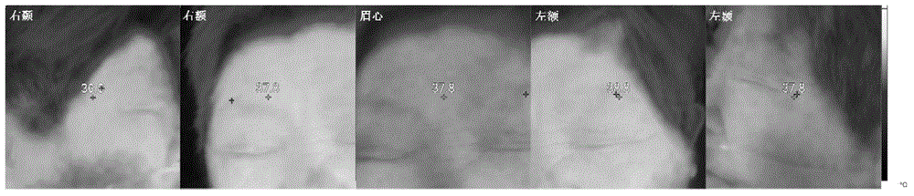 Array type infrared thermal imager and application of array type infrared thermal imager to identifying ischemic stroke and hemorrhagic stroke at early stage