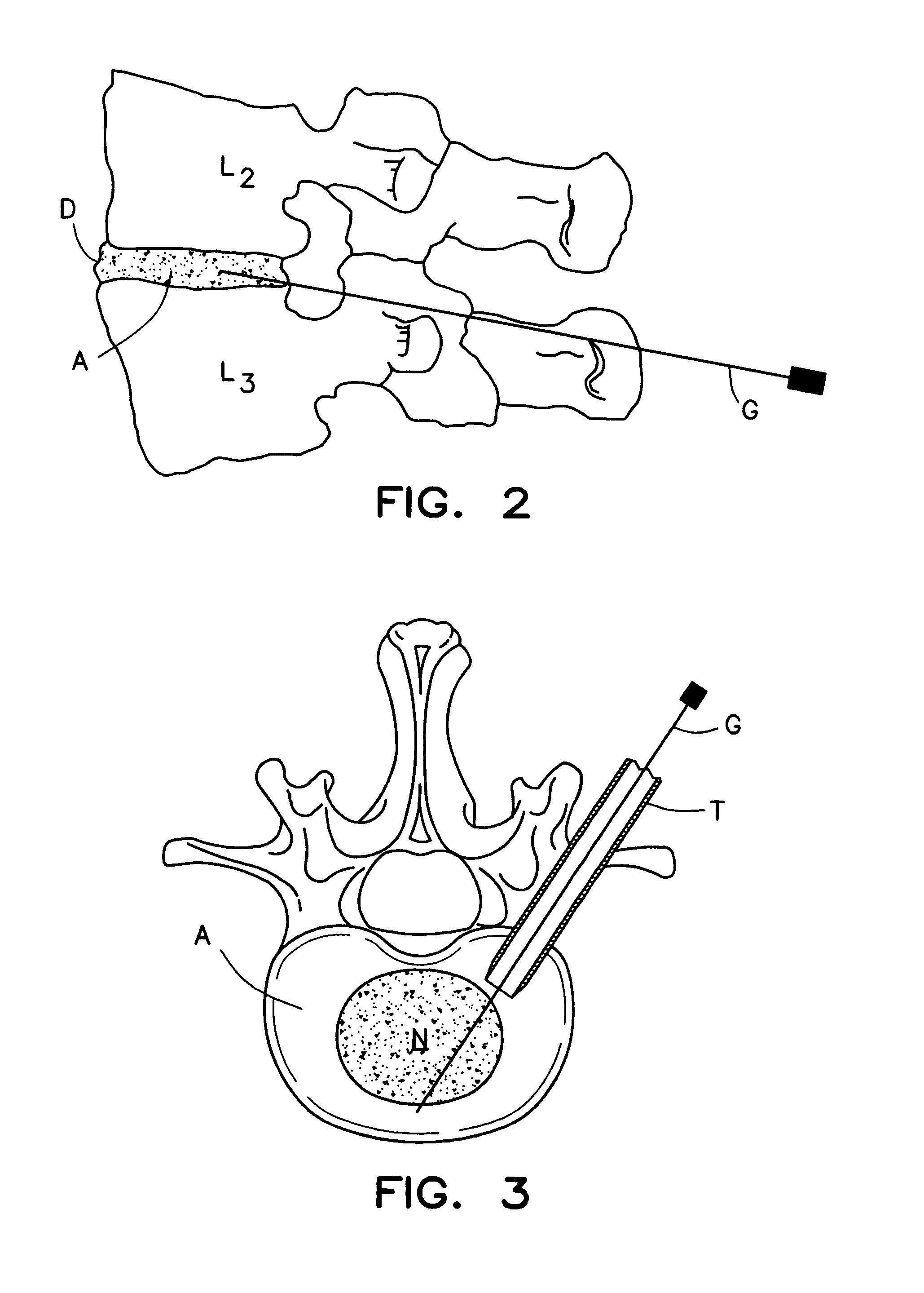 System and method for the pretreatment of the endplates of an intervertebral disc