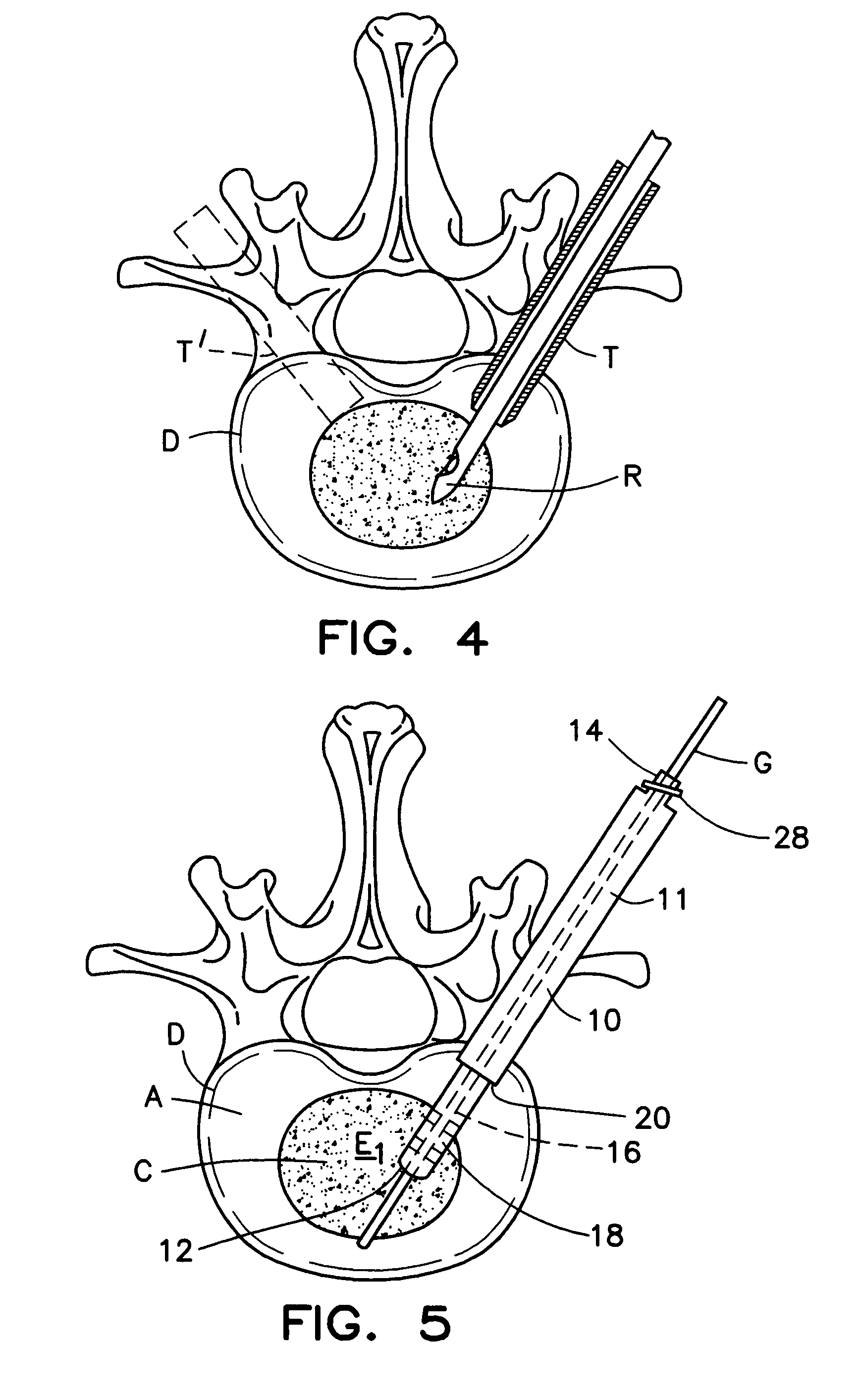 System and method for the pretreatment of the endplates of an intervertebral disc