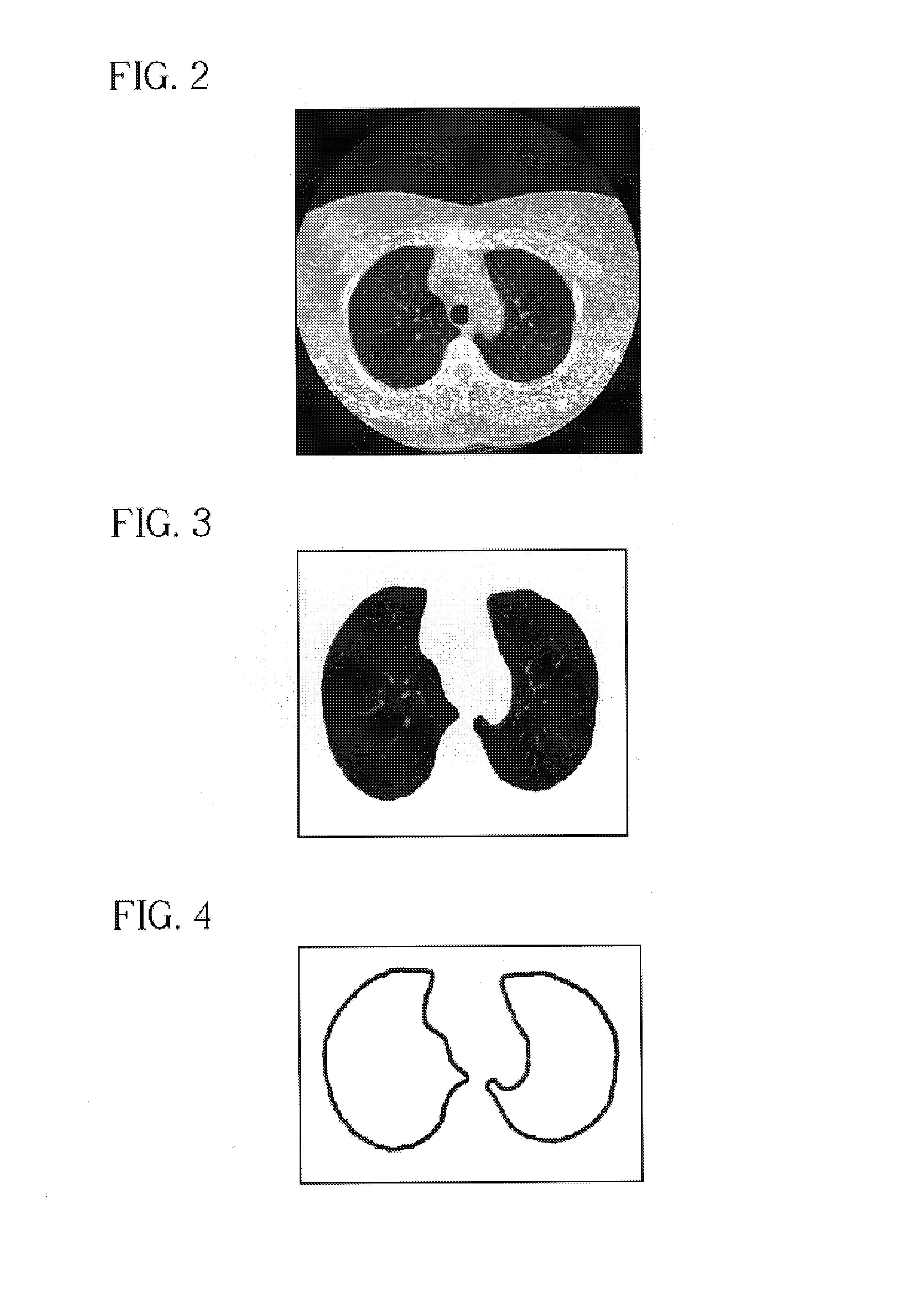 System, method and apparatus for small pulmonary nodule computer aided diagnosis from computed tomography scans
