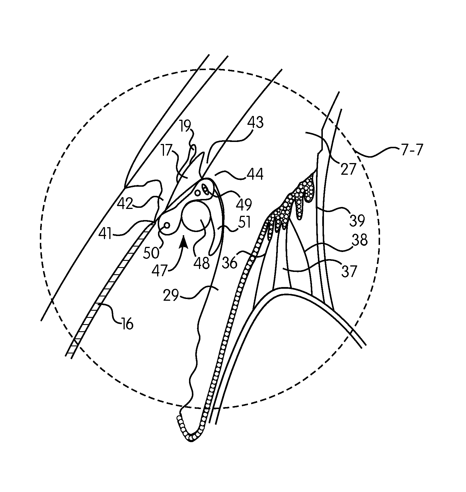 Ocular collar stent for treating narrowing of the irideocorneal angle