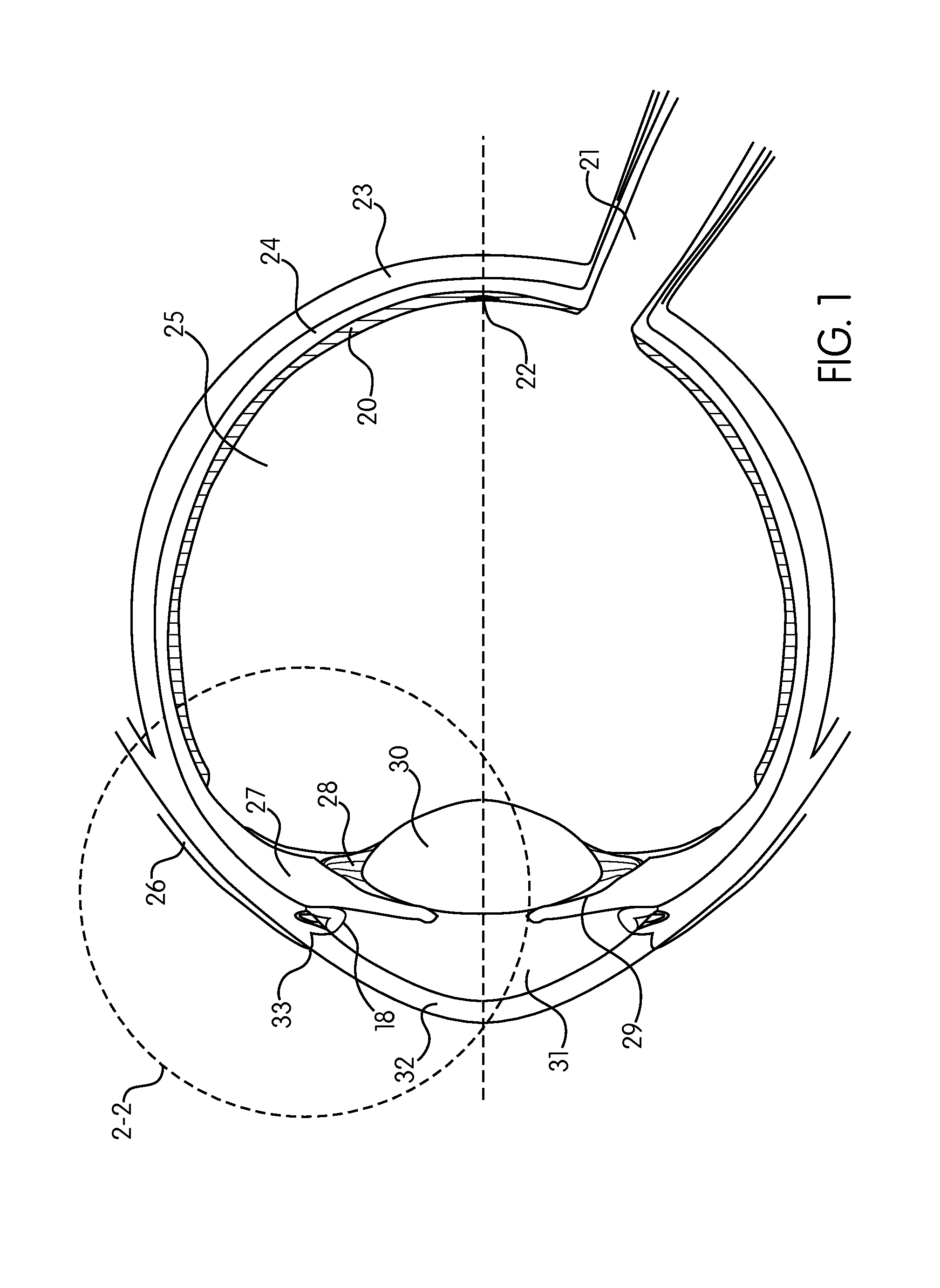 Ocular collar stent for treating narrowing of the irideocorneal angle