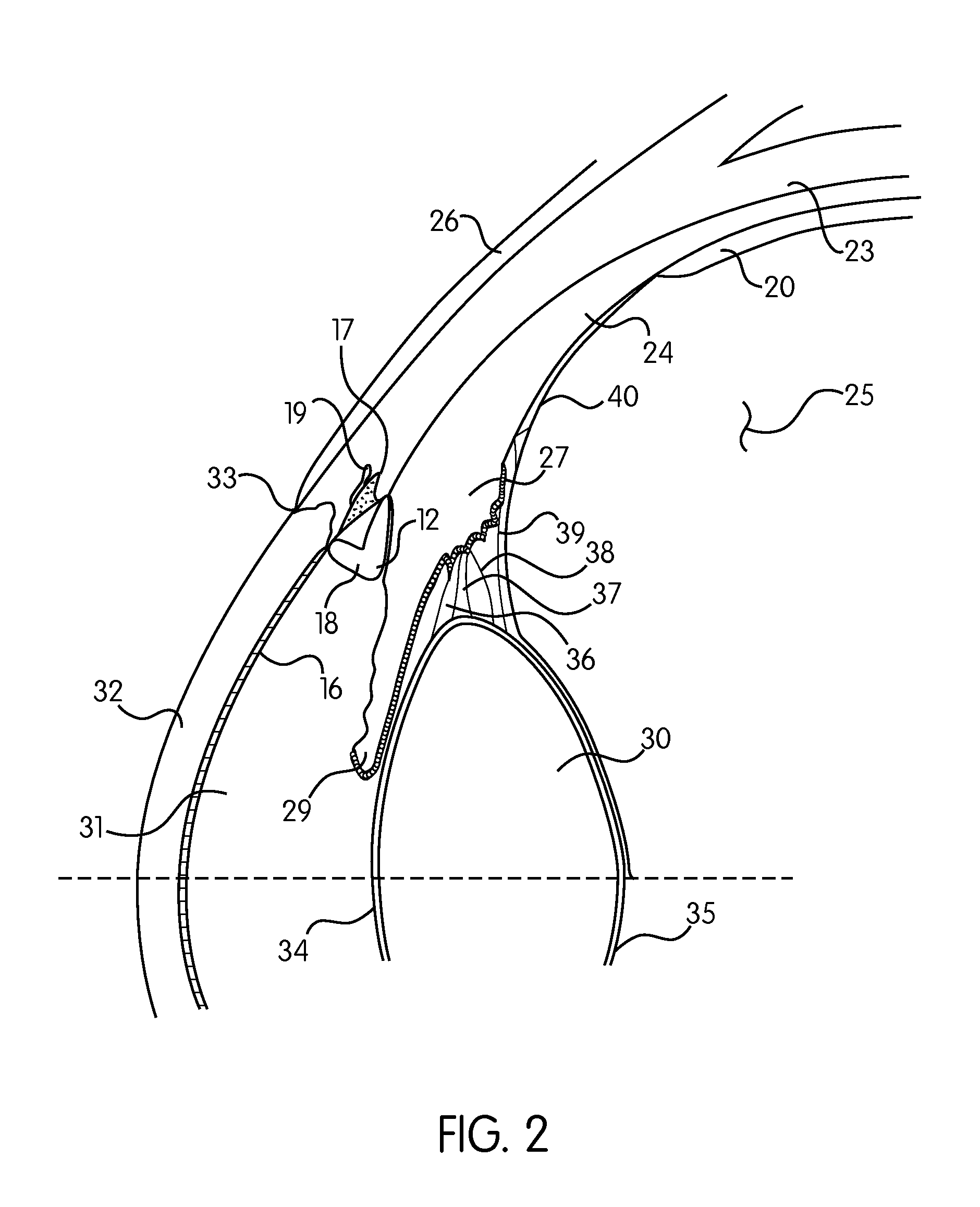 Ocular collar stent for treating narrowing of the irideocorneal angle