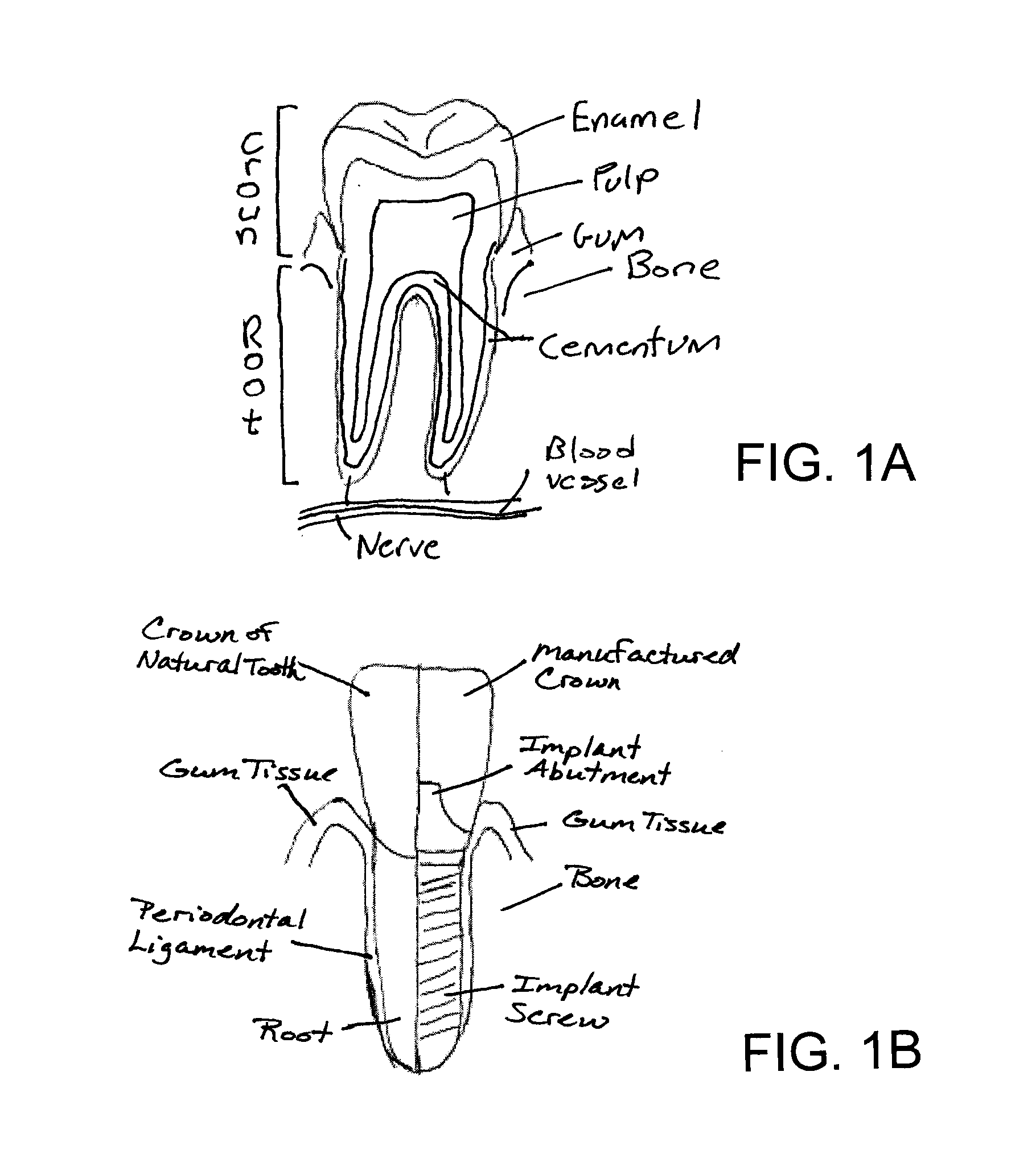 System, Method And Apparatus For Tooth Implants