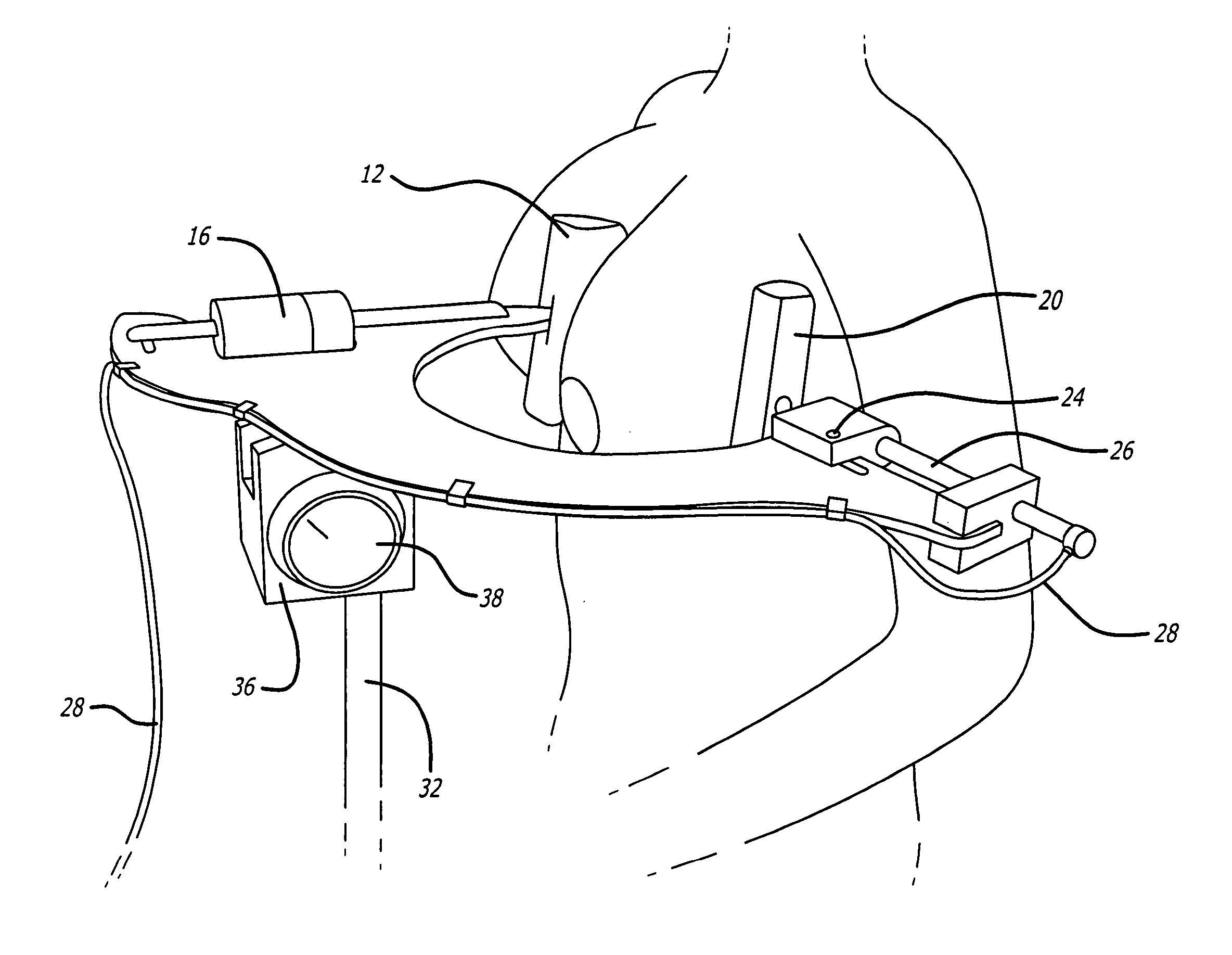 Capsular contracture preventing and relieving device