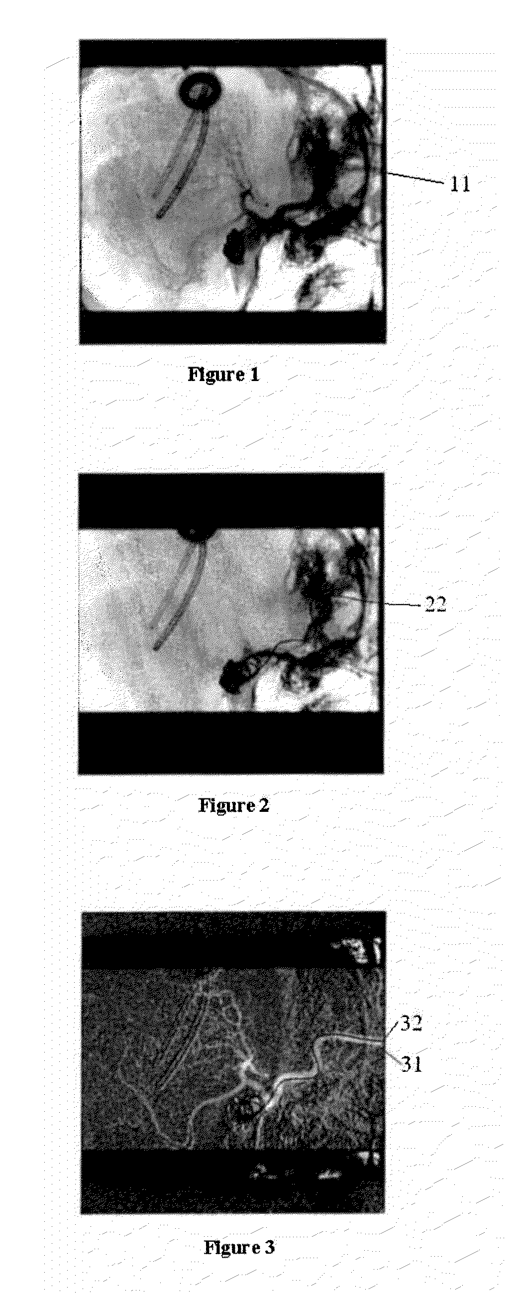 System and method for decomposed temporal filtering for X-ray guided intervention application