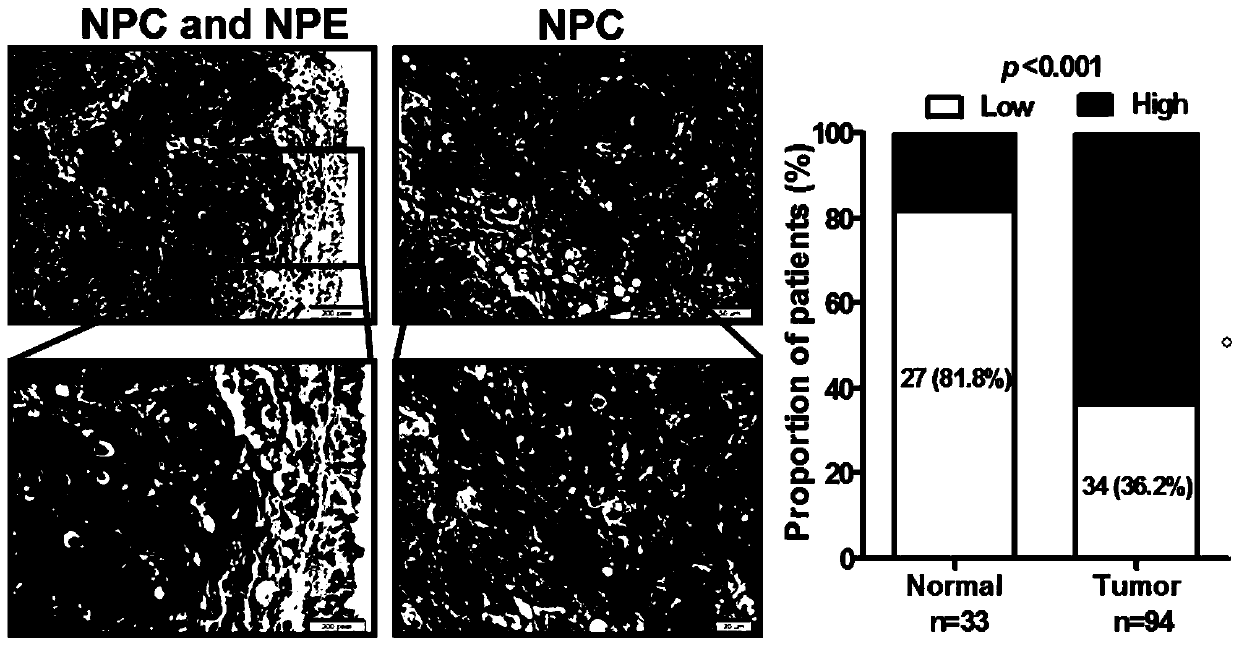 Reagent for interfering with the expression of long-chain non-coding RNA PVT1 and its application