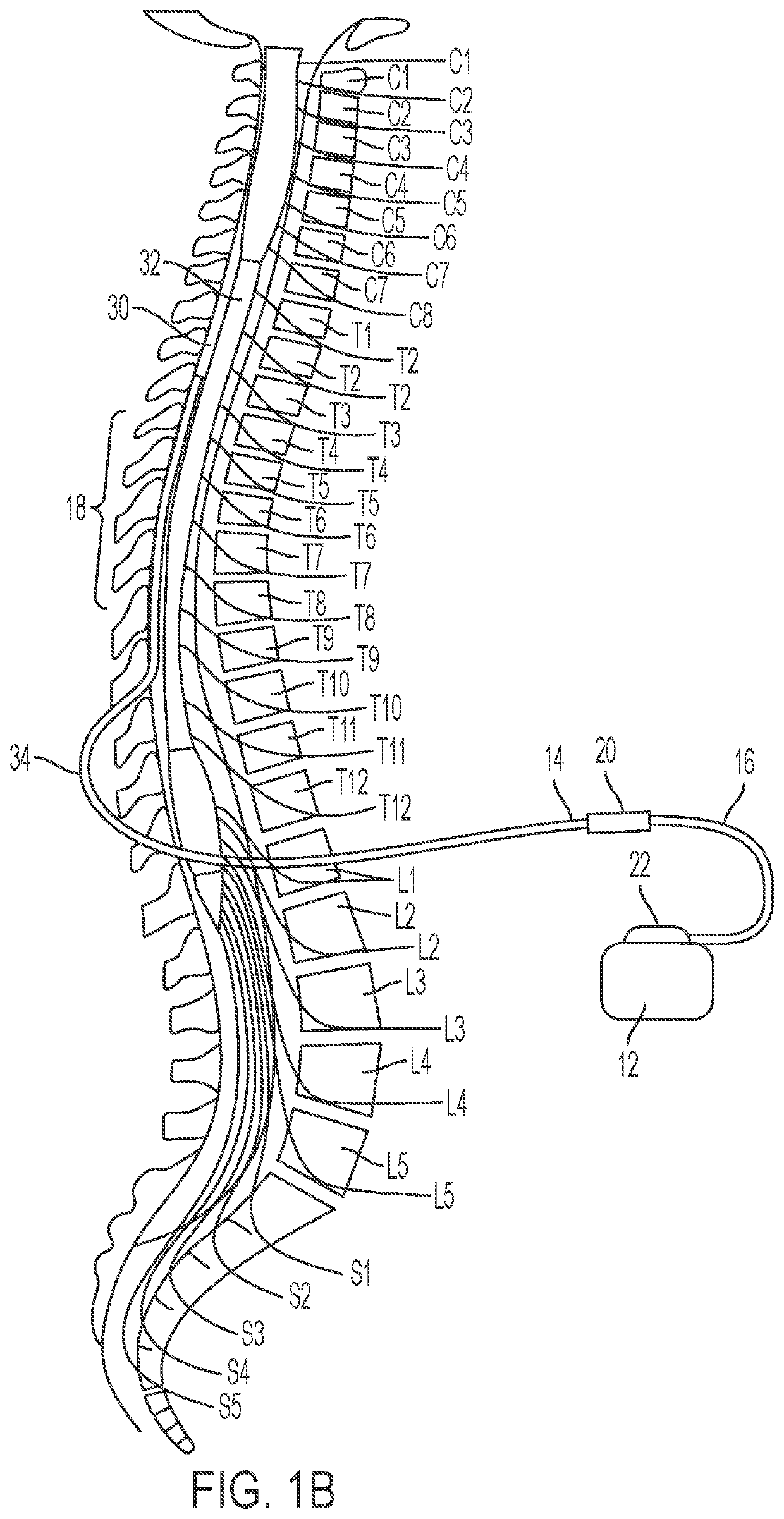Bulkhead anchor for medical device leads
