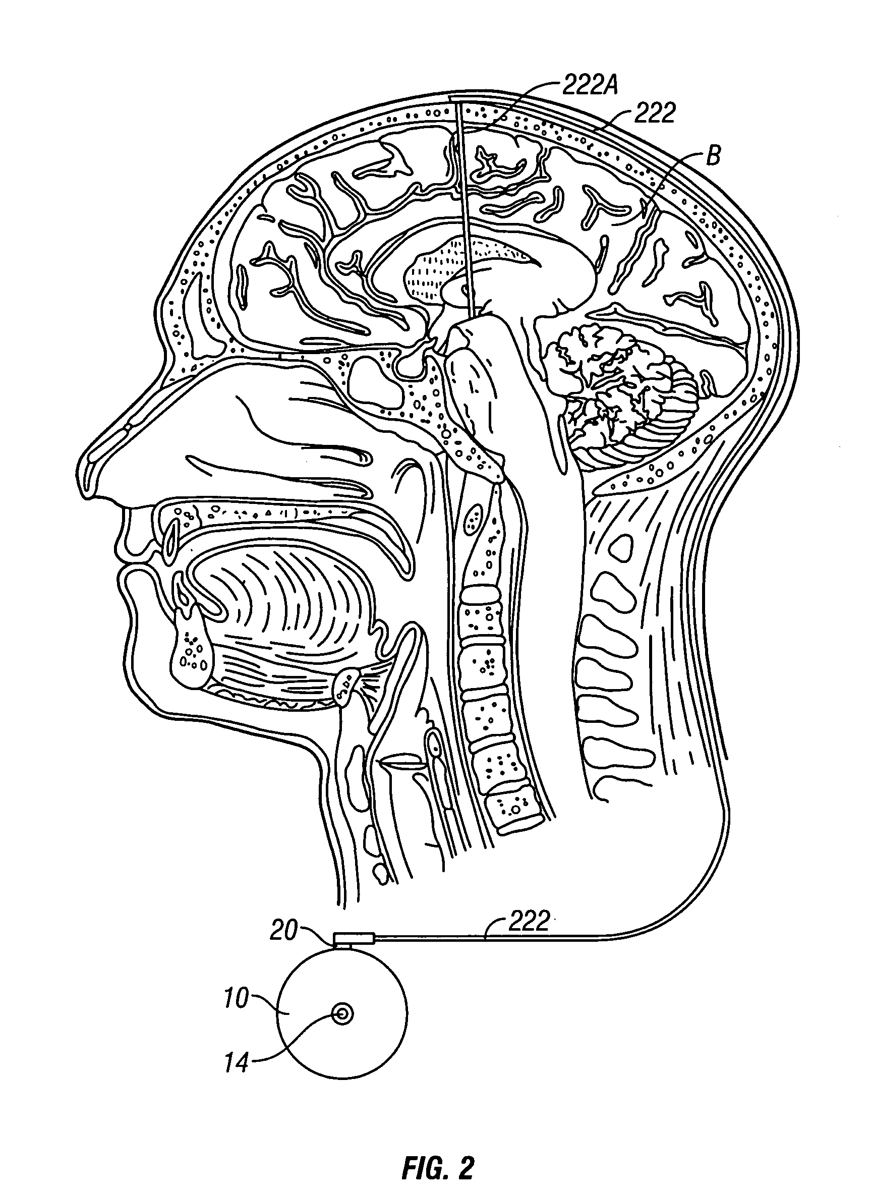 System and method of treating stuttering by neuromodulation