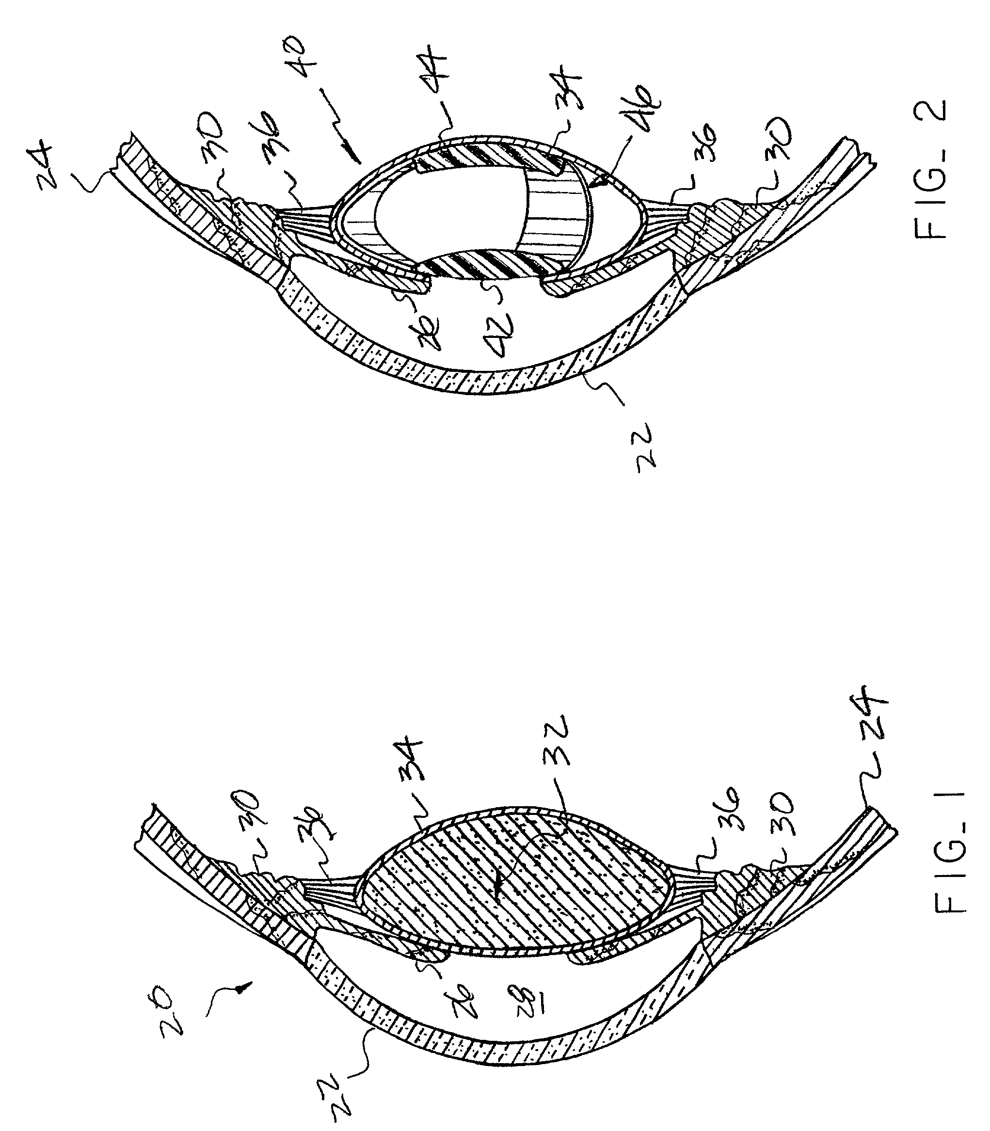Open chamber, elliptical, accommodative intraocular lens system