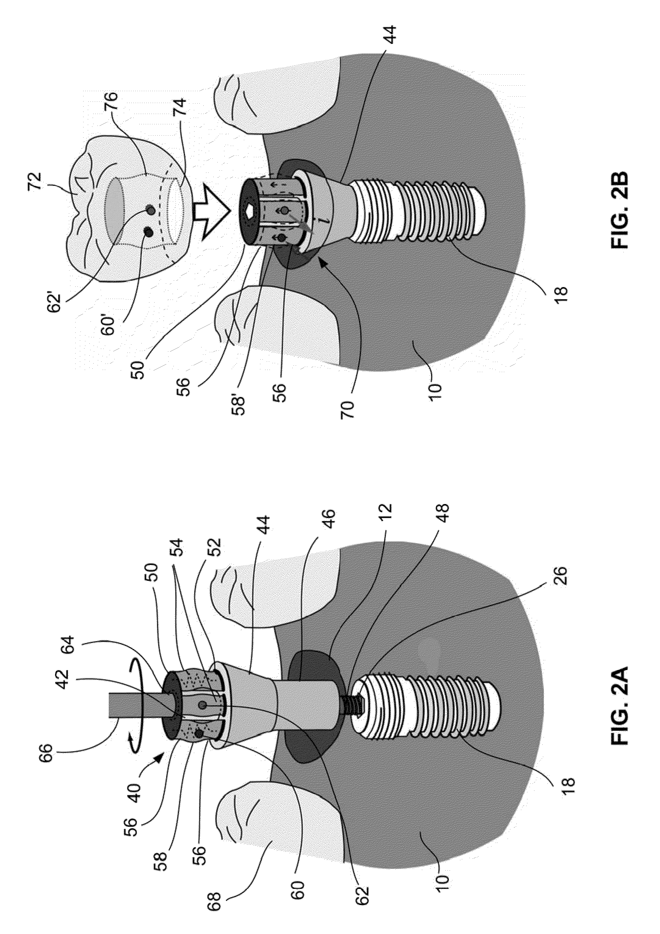 Shape memory dental retention systems