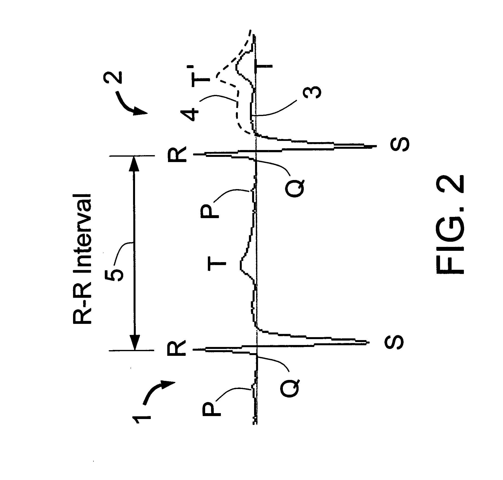 Means and method for the detection of cardiac events