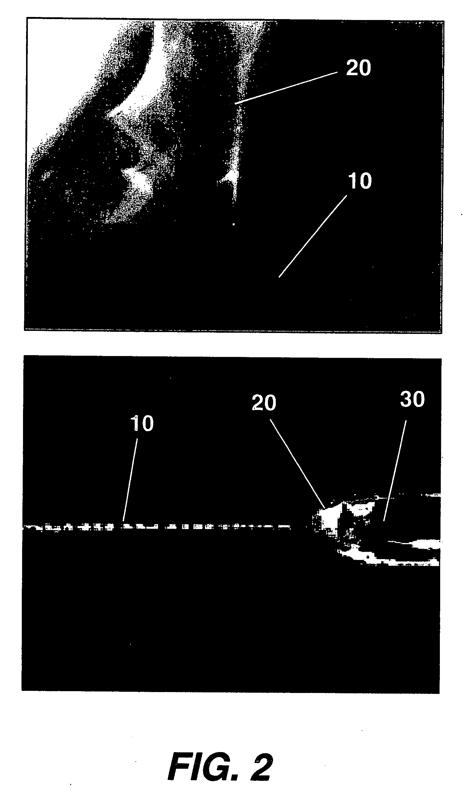 Method for stromal corneal repair and refractive alteration