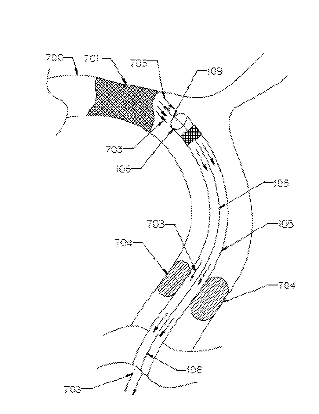 Methods and Devices for Removal of Thromboembolic Material