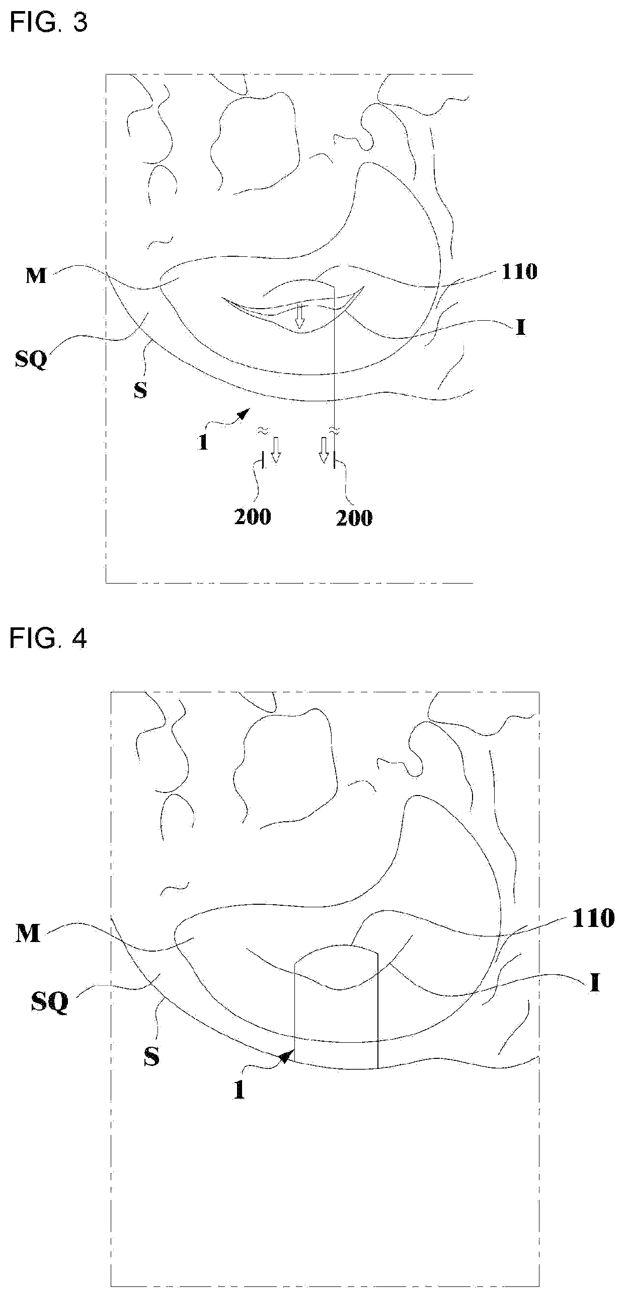 Bidirectional barbed suture having needle and treatment method using the same