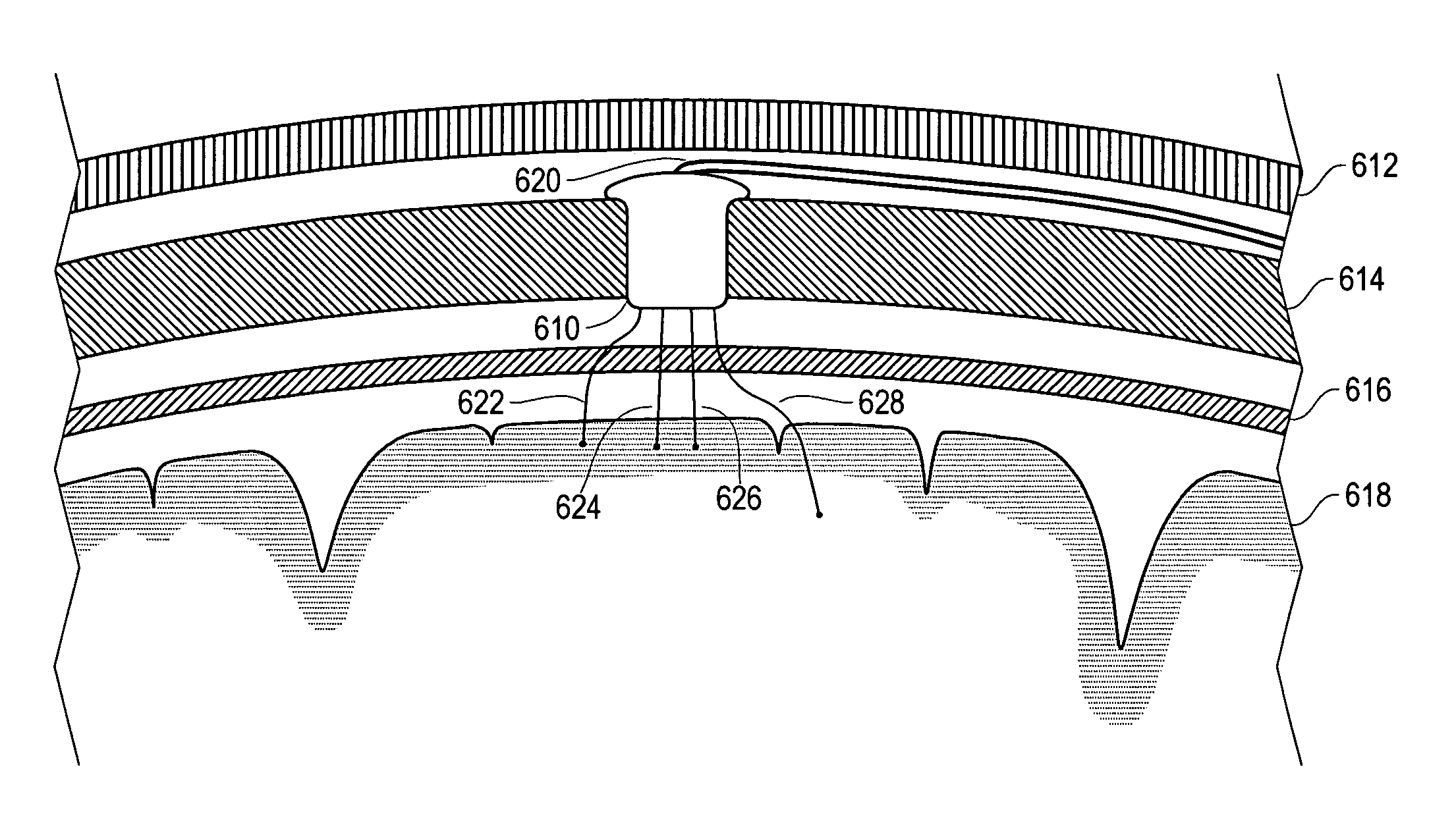 Implantable lead system with seed electrodes