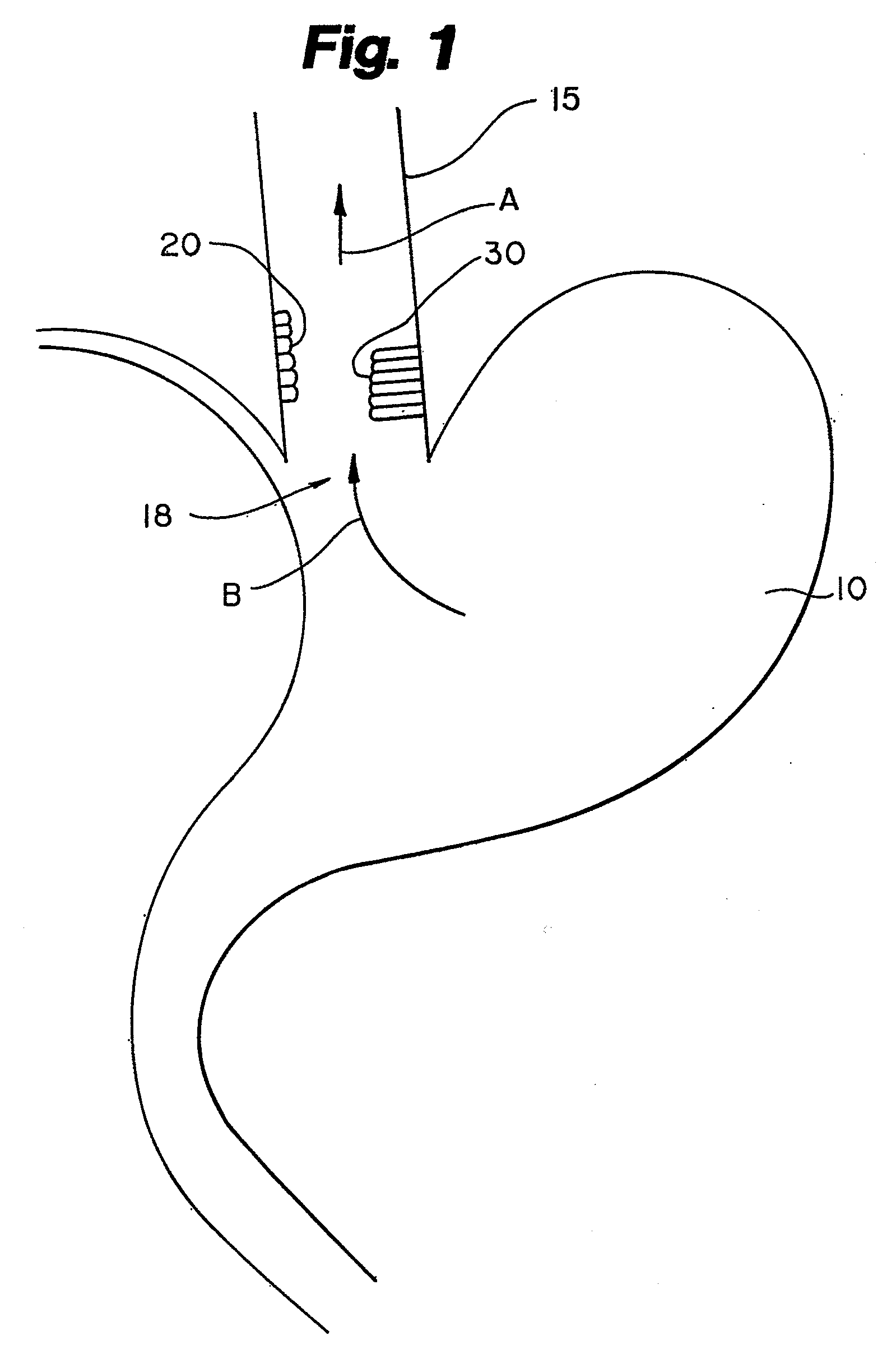 System and method of treating abnormal tissue in the human esophagus